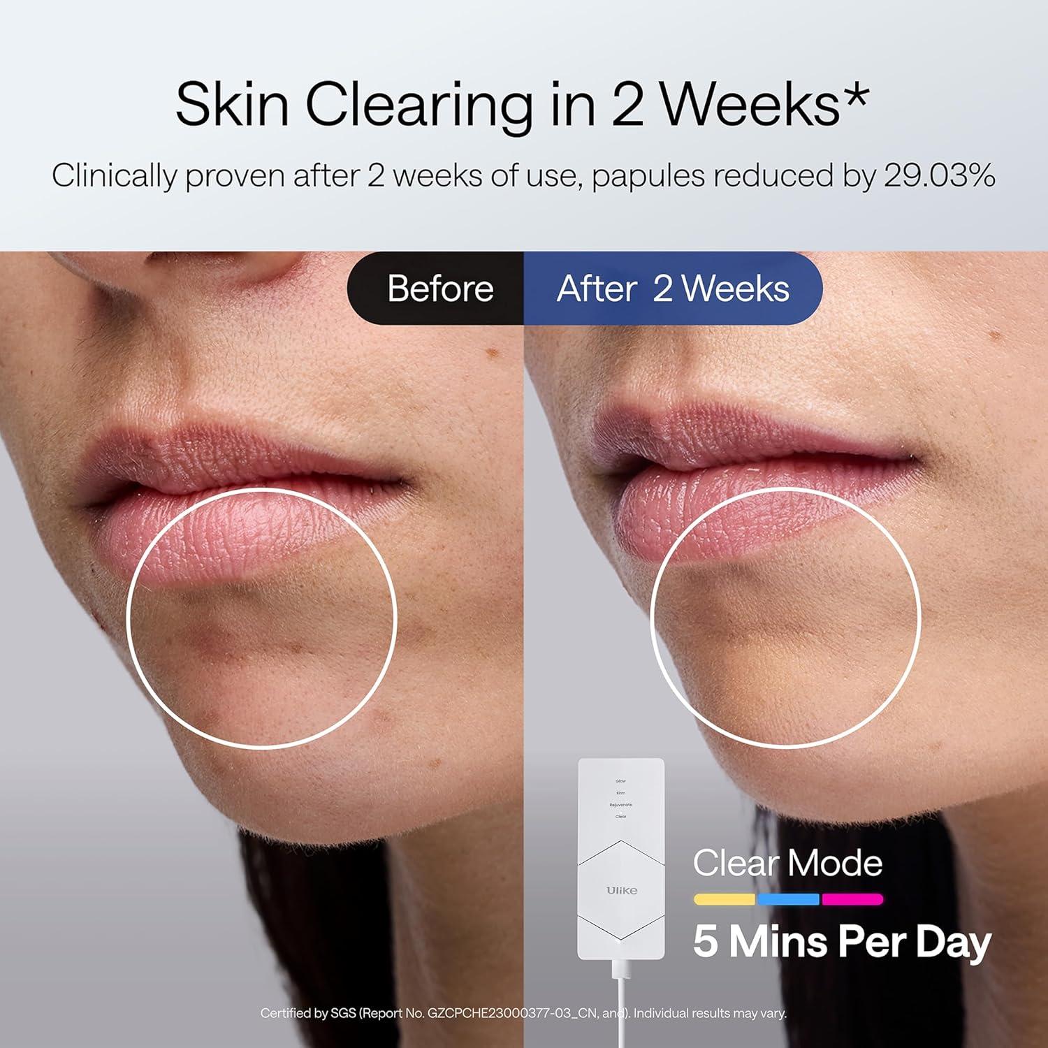 Máscara de Terapia de Luz LED Ulike ReGlow 272 Perlas 100W