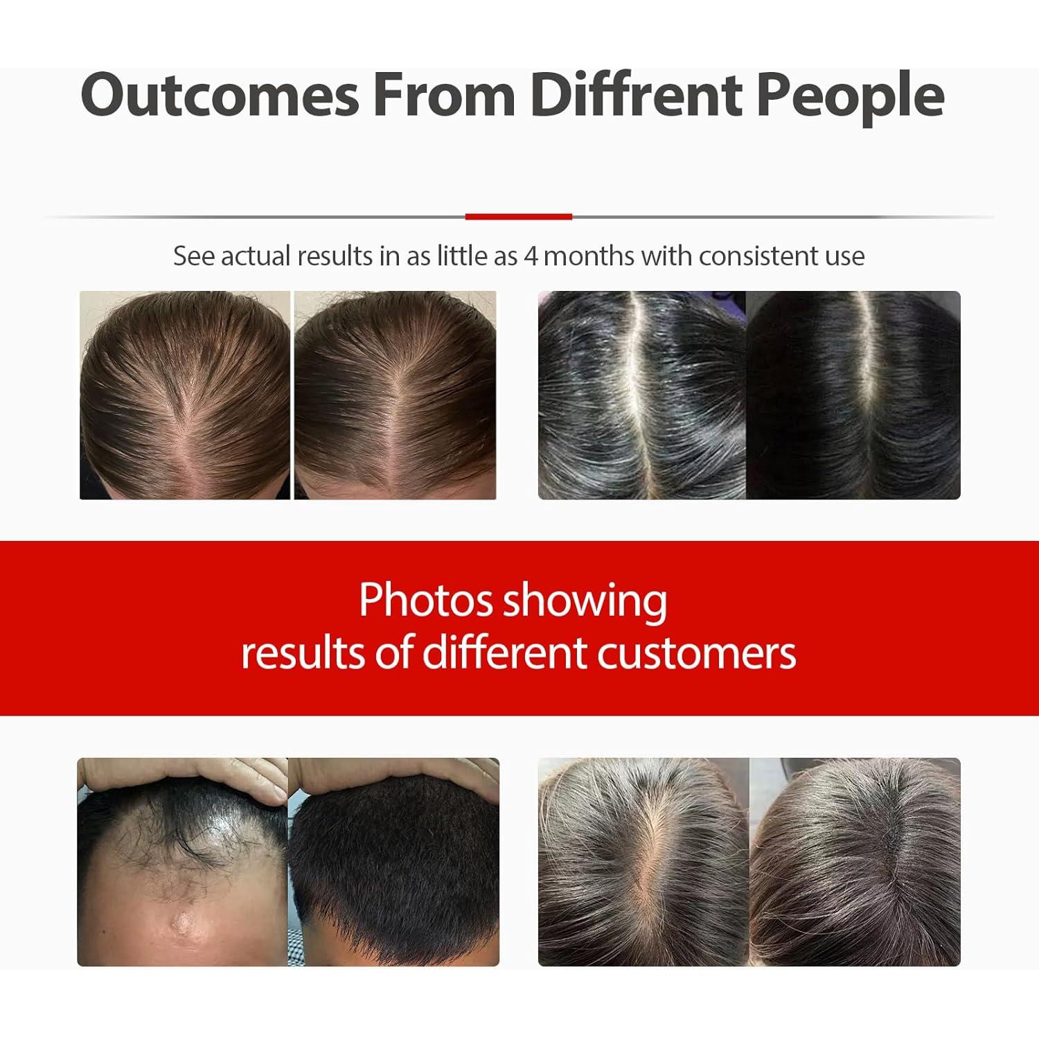 Gorro de Crecimiento Capilar Carviki con Láser y Batería