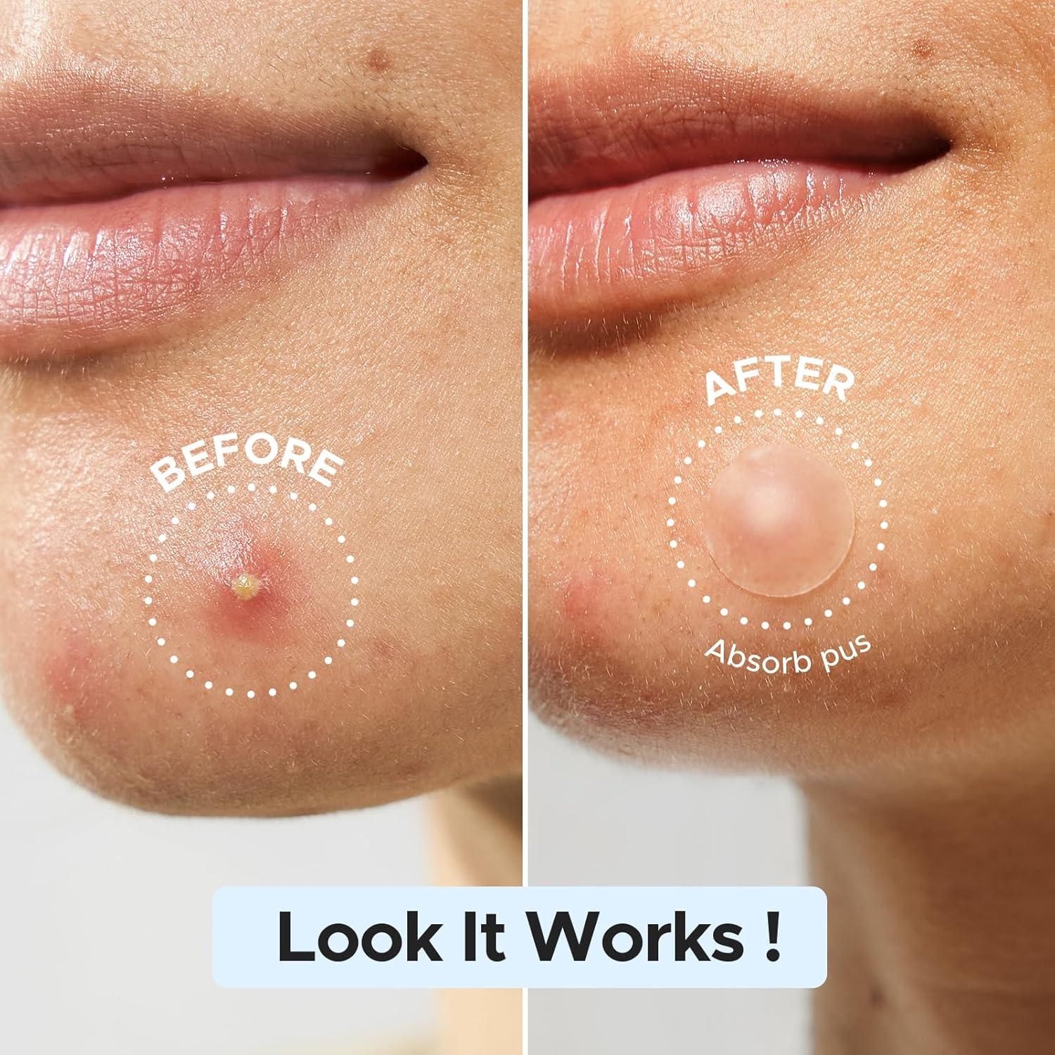 Parches para Granos LitBear - 480 Parches Hidrocoloides