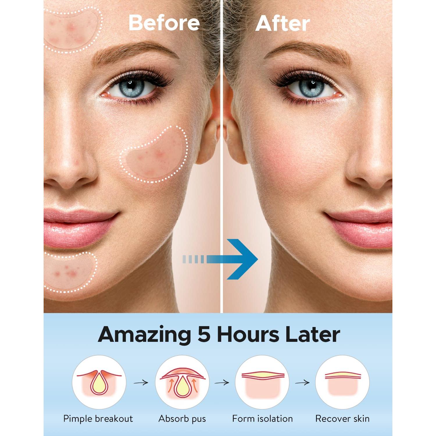 Parche Hidrocoloide Grande LitBear para Acné - 20 Parches