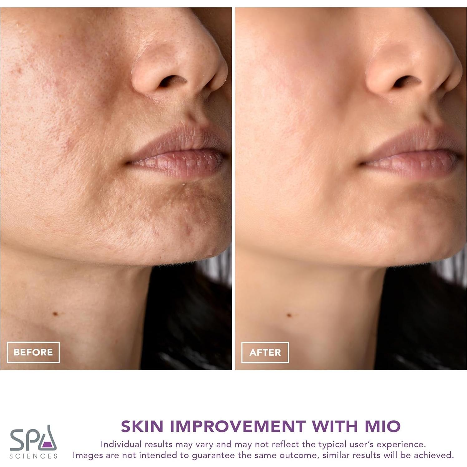 Spa Sciences MIO Microdermoabrasión Diamante Rejuvenecedor Piel