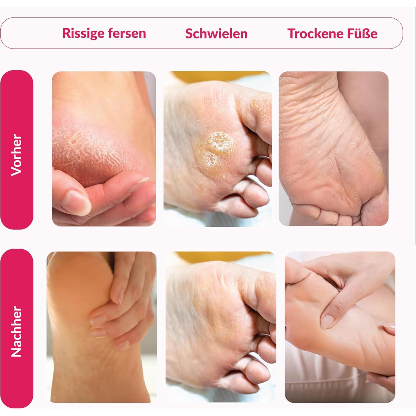 Mascarilla Exfoliante para Pies Summer Foot - 1 Par - Extractos de Pepino y Urea