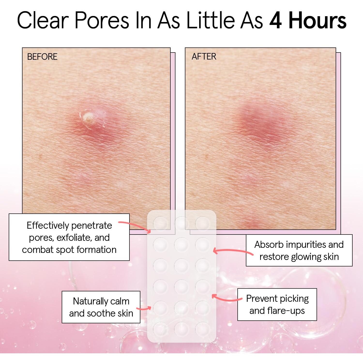 Parches para Acné Hidrocoloides Grace & Stella - 36 Piezas