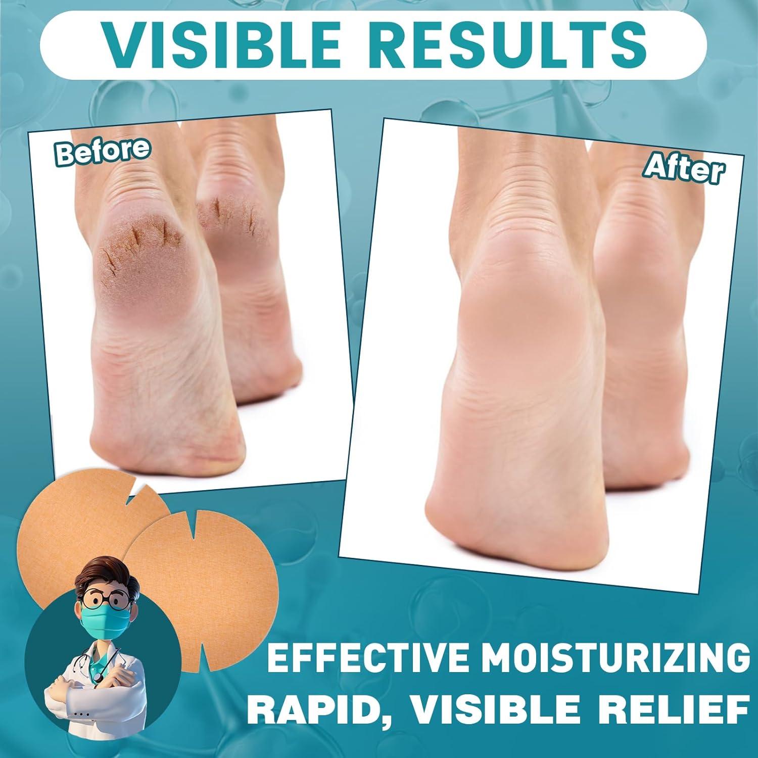 30 Parches Adhesivos TEAWOO para Talones Agrietados 80mm