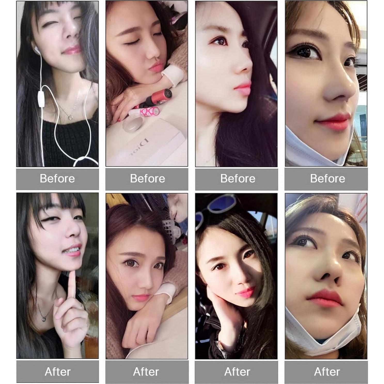 Elevador de Nariz Invisible VANANA - 3 Tamaños Silicona Suave