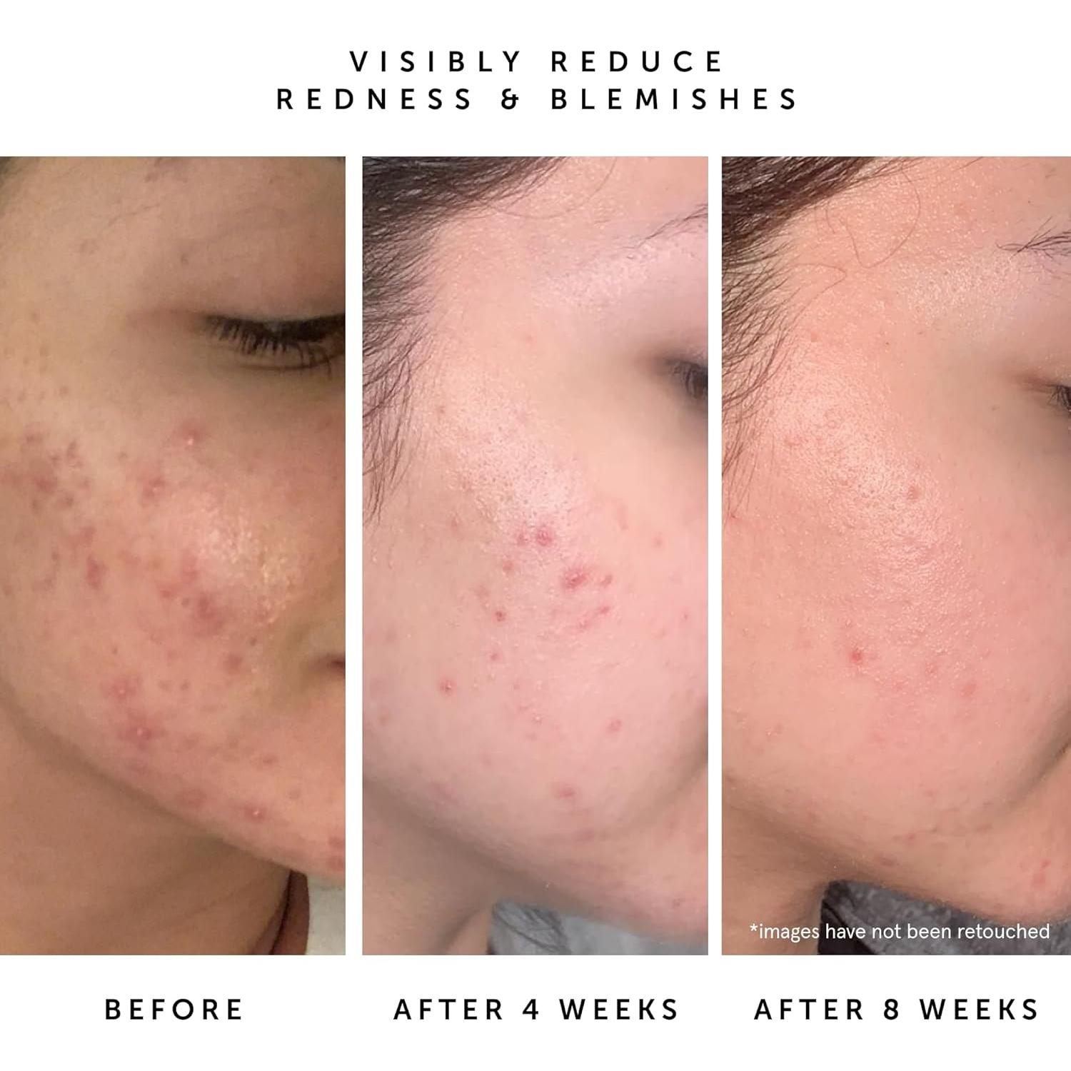 Aceite Facial Equilibrante Herbivore Lapis 50 ml - Piel Acnéica