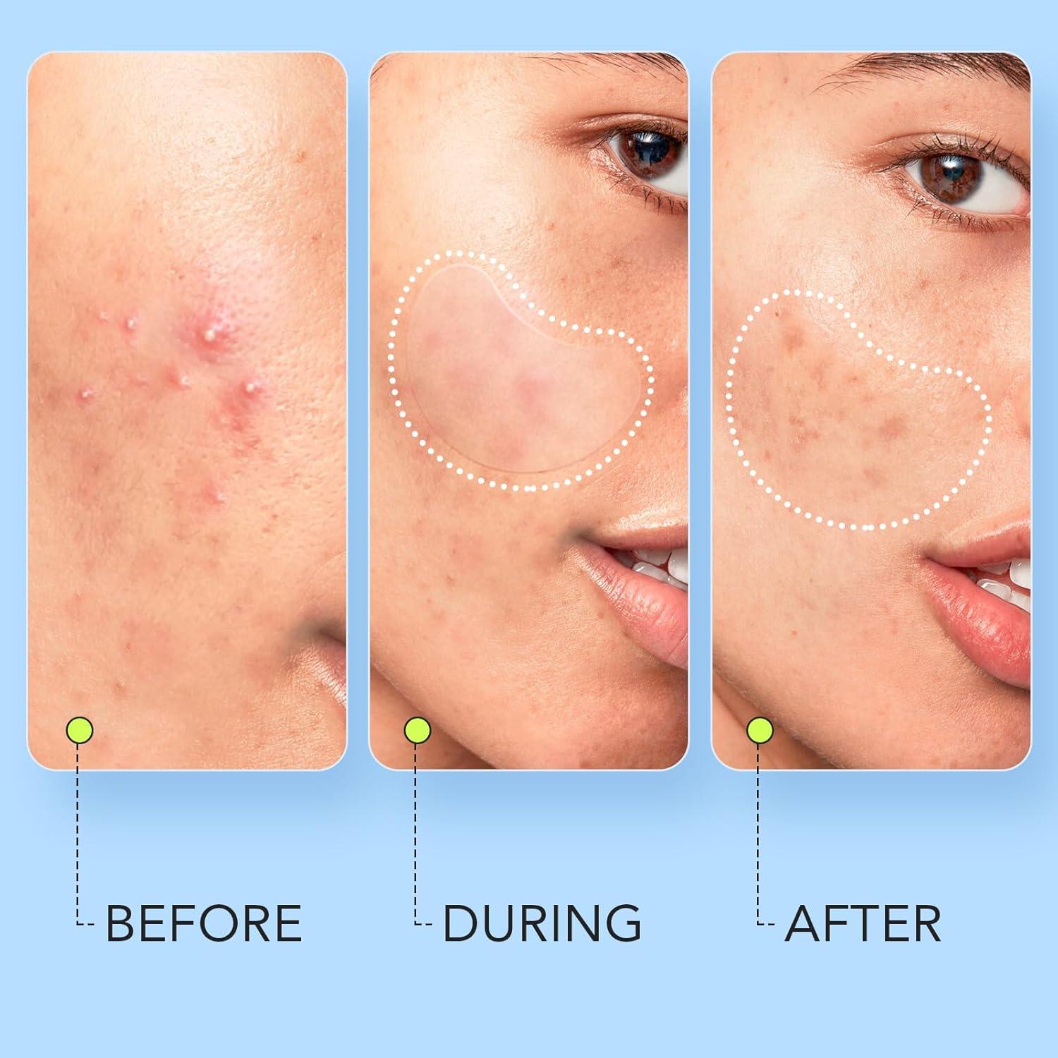 Parches Hidrocoloides para Granos LitBear - 112 Unidades XL