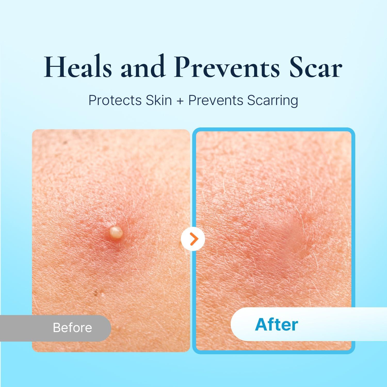 Parche Discreto para Acné DERMAKR - 72 Parches Hidrocoloide