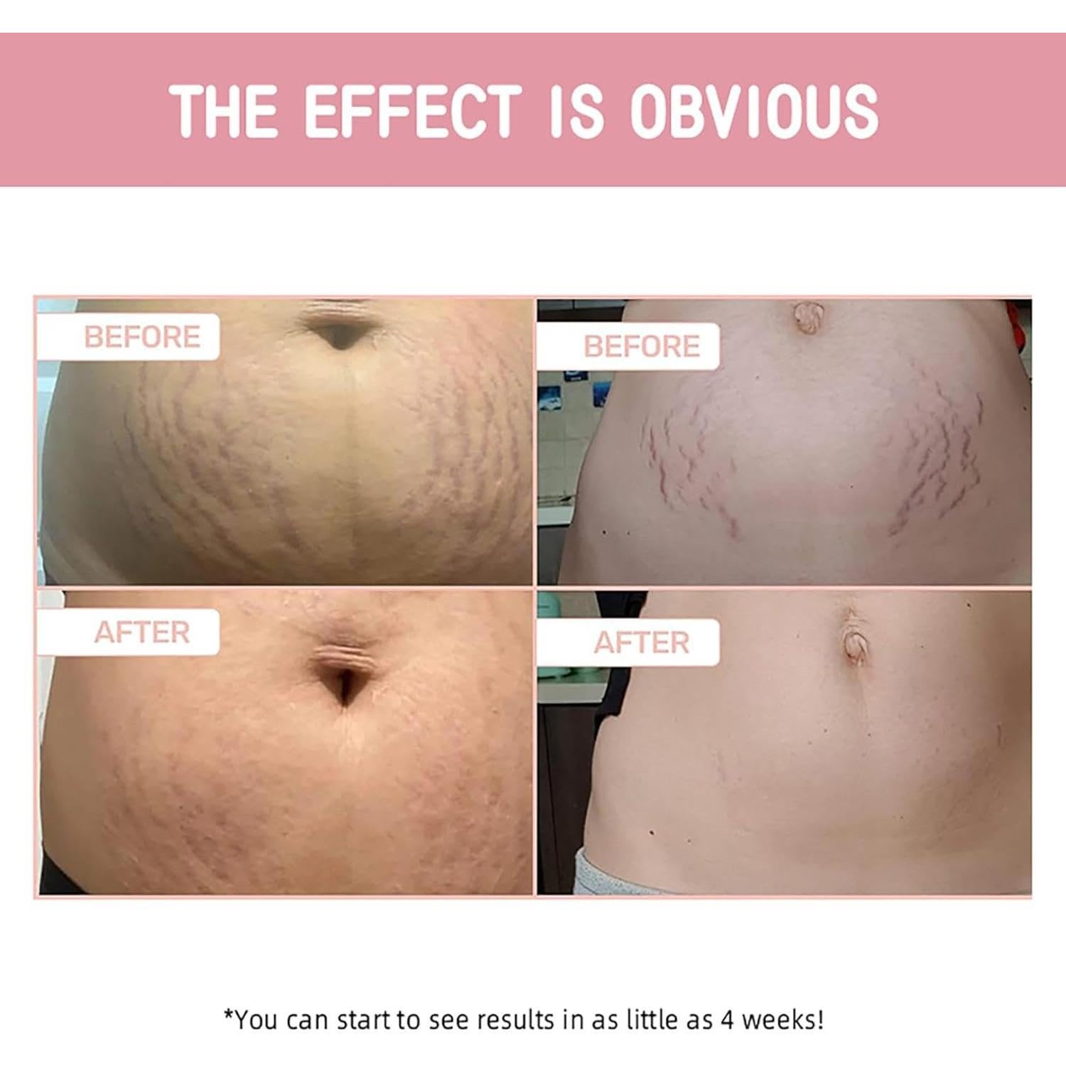 Crema Reafirmante B FLAT 100ml para Vientre y Estrías