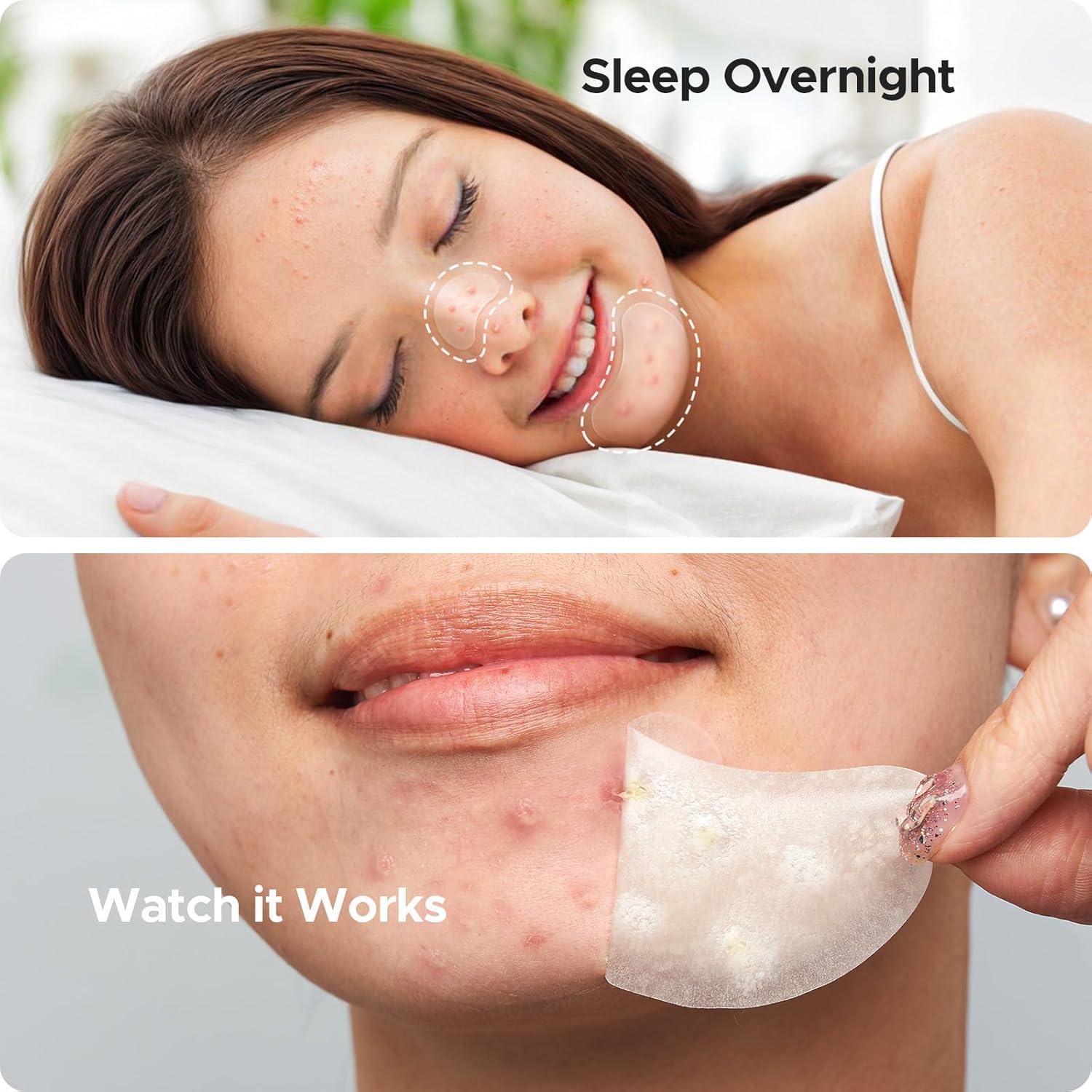 Parche Hidrocoloide para Acné TKTK - 100 Unidades, 6 Tamaños