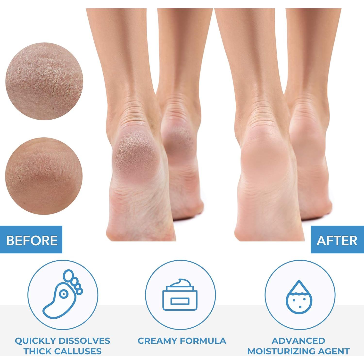 Removedor de Callos ForPro 32 oz. Fórmula Hidratante Rápida