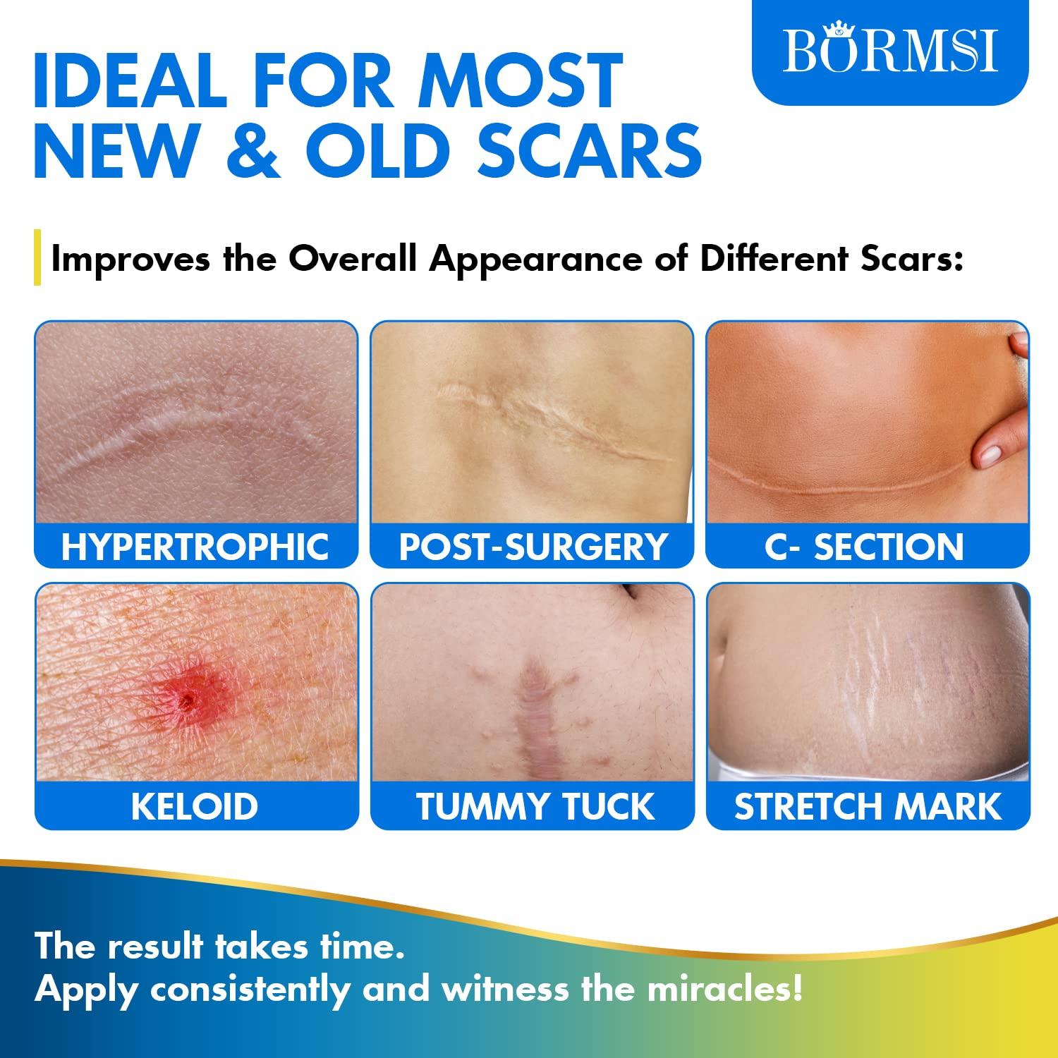 Crema para Cicatrices BORMSI 50g Gel de Silicona Avanzada