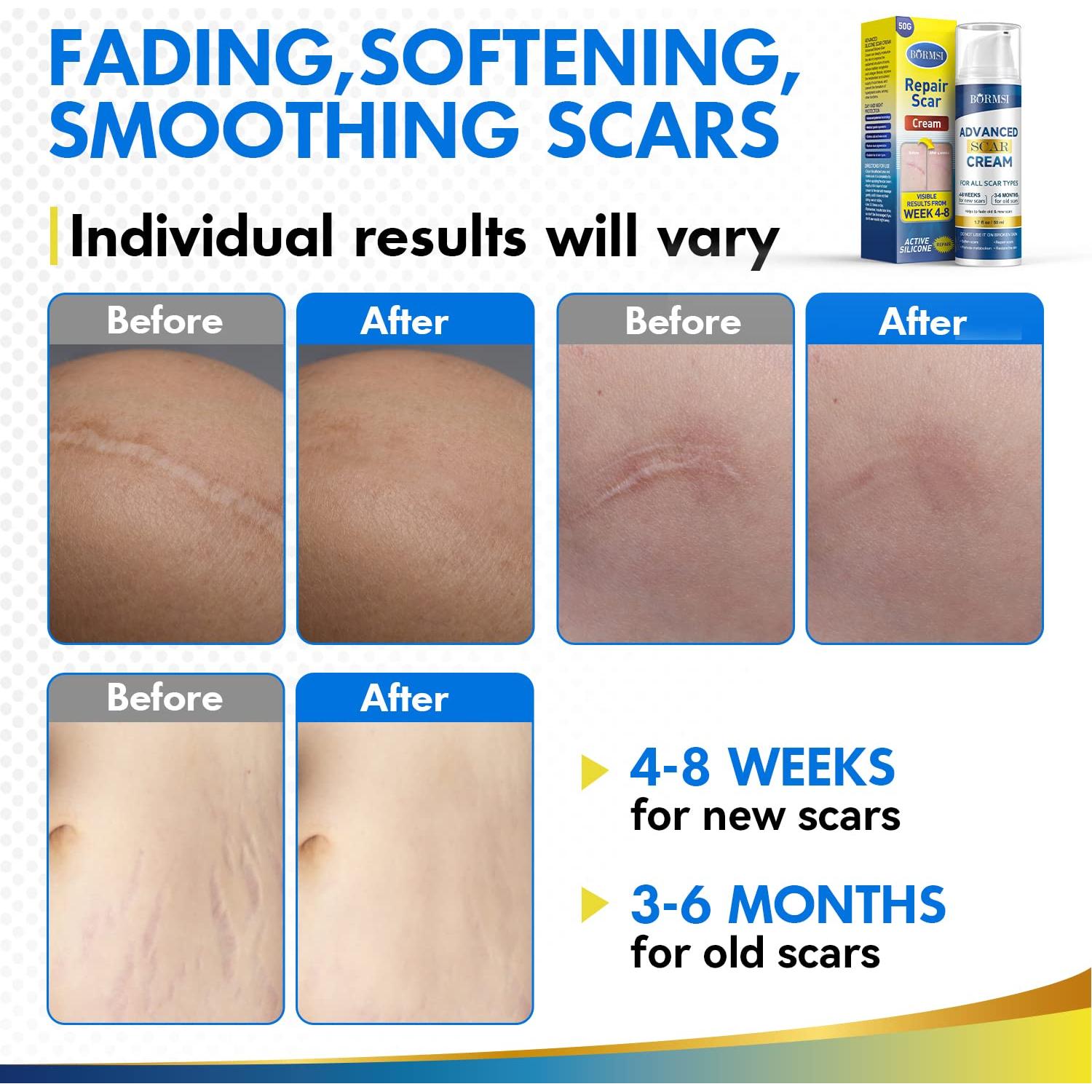 Crema para Cicatrices BORMSI 50g Gel de Silicona Avanzada