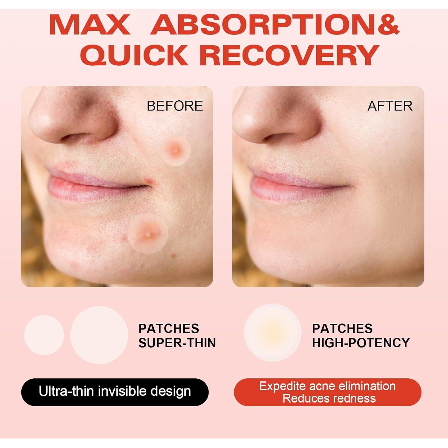 Parches Microdarts Pro Gtyuoo para Acné - 144 Piezas