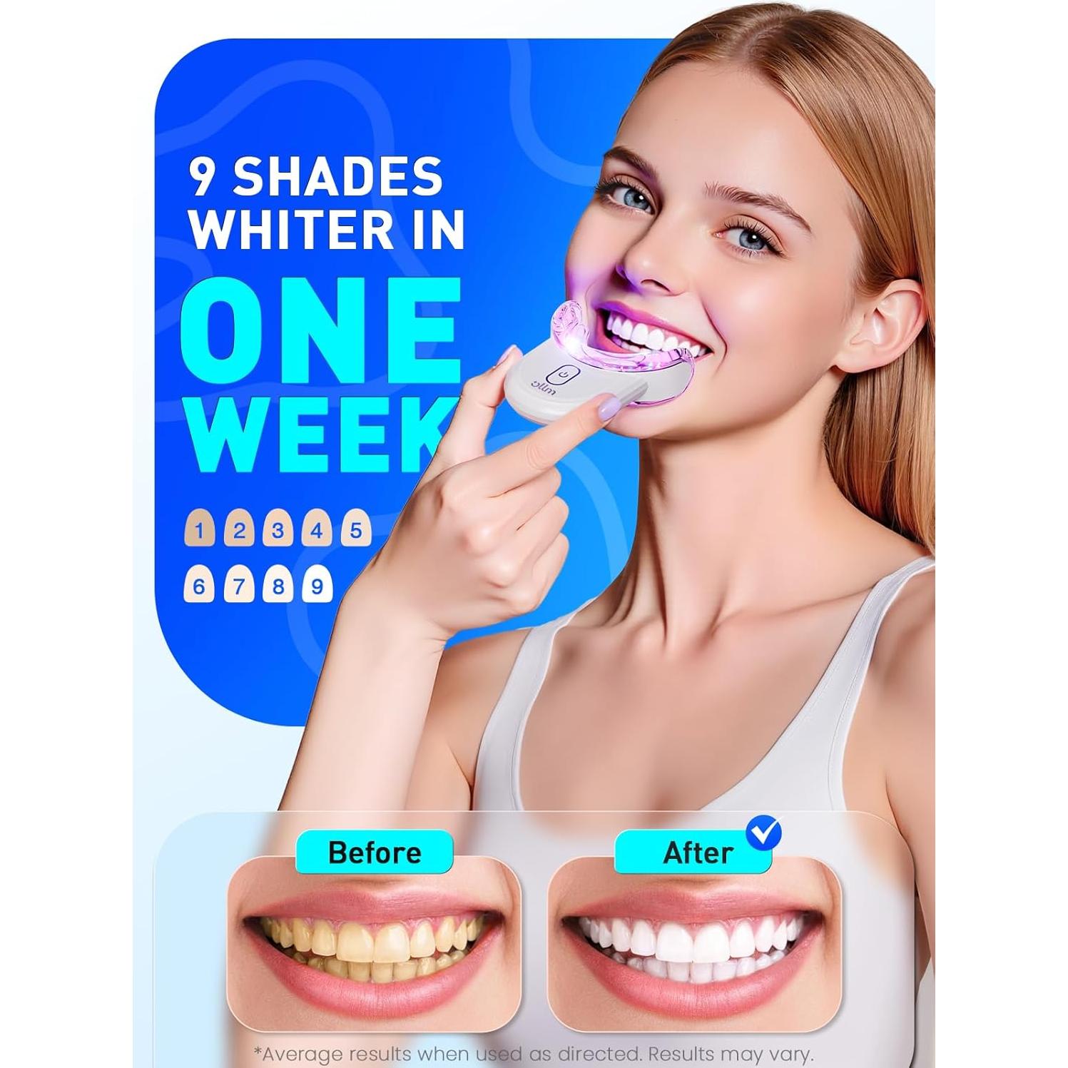 Kit de Blanqueamiento Dental OLLM para Dientes Sensibles