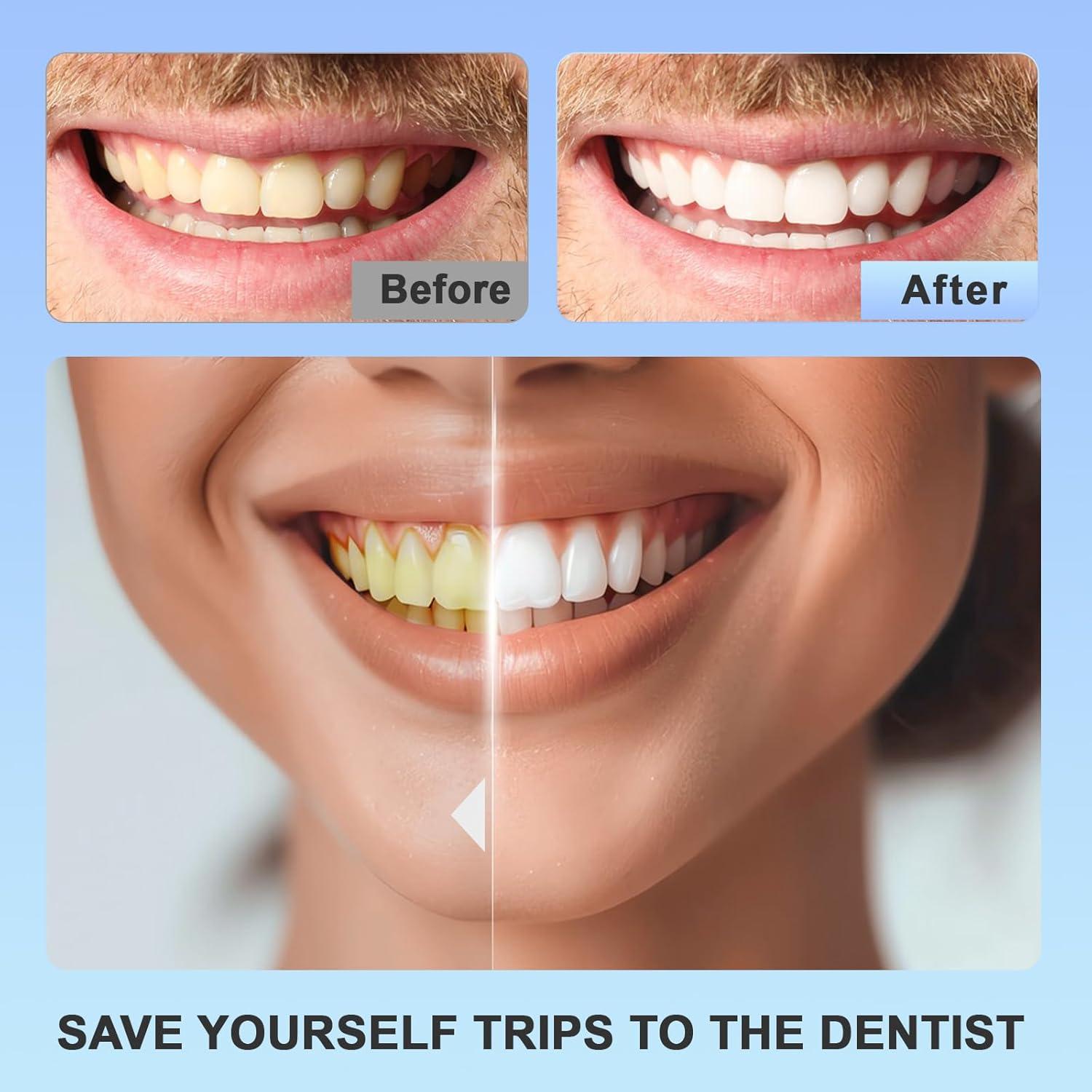 Kit de Tiras Blanqueadoras de Dientes Gpoizmo - 14 Tratamientos