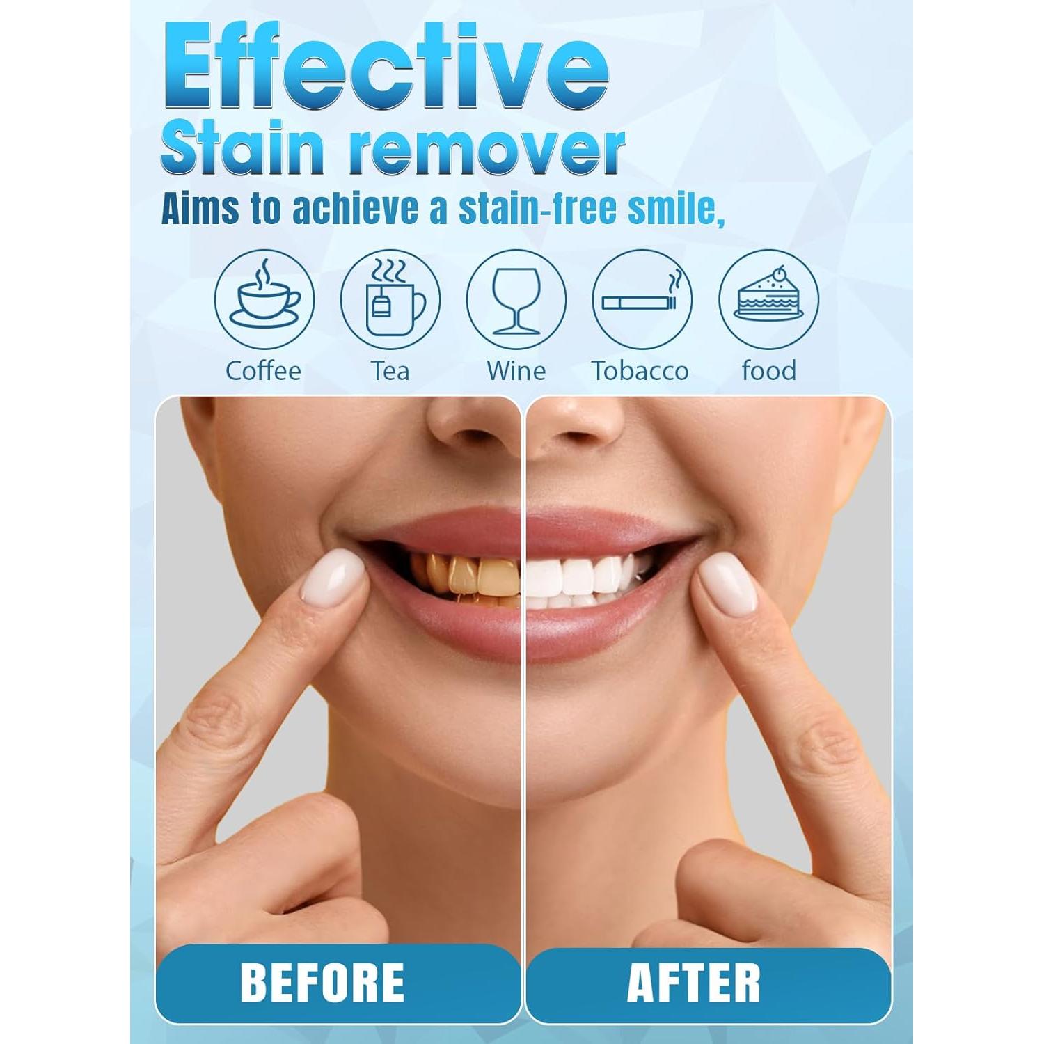 Kit de Blanqueamiento Dental OLLM con Luz LED y Gel 35%