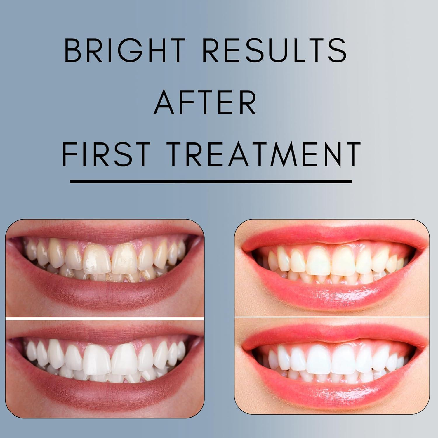 Gel Blanqueador Dental Cool 44% Peróxido Carbamida - 50 Tratamientos