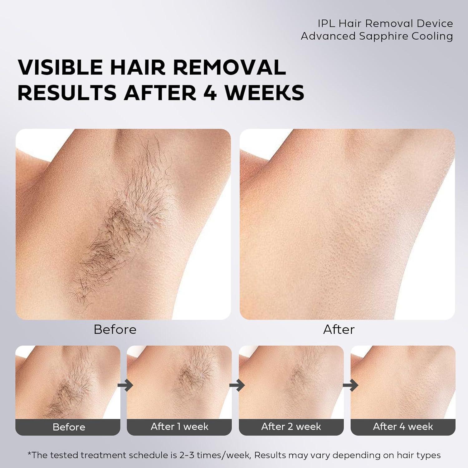 Epilador IPL EUARNE Indoloro con Enfriamiento por Hielo 298g