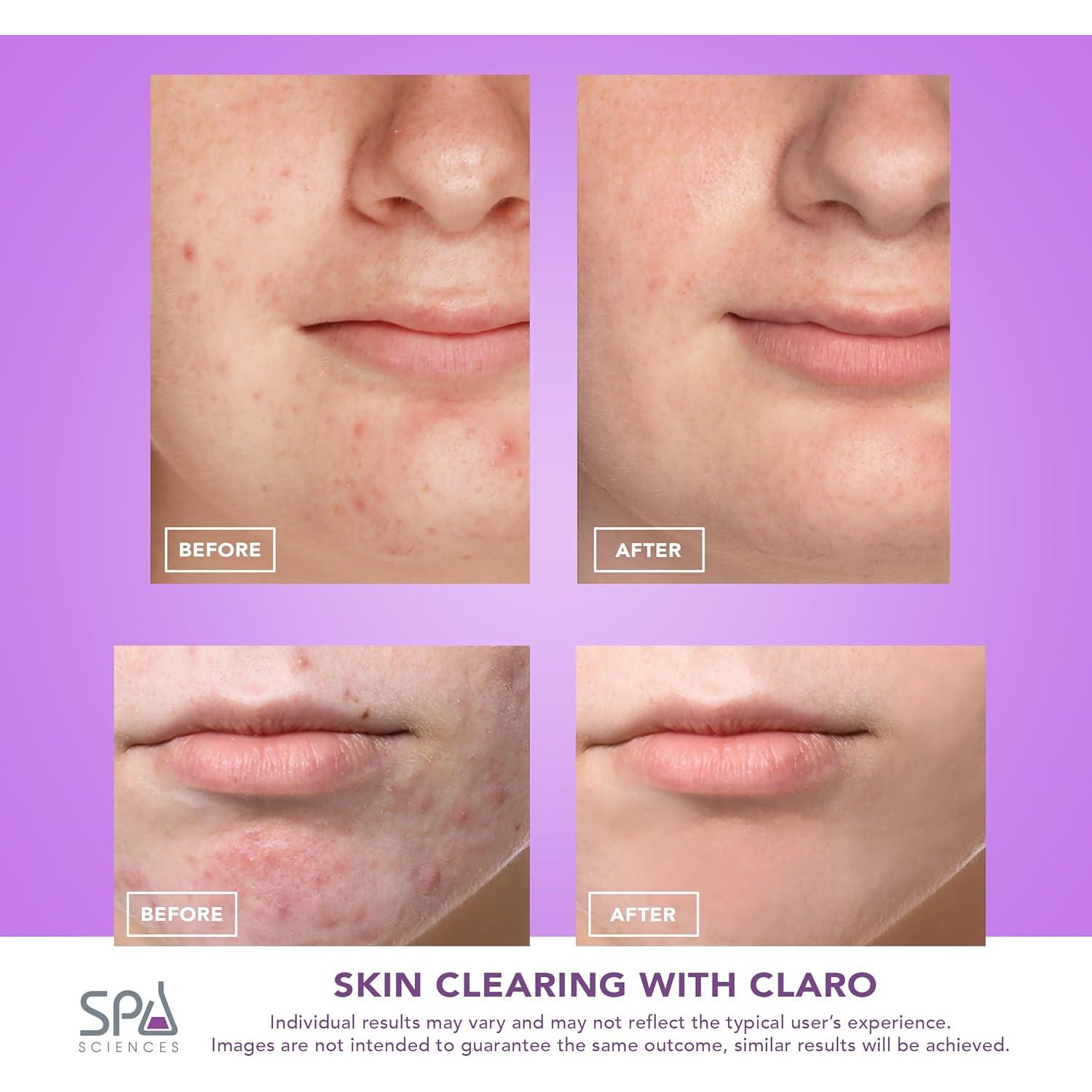 Spa Sciences CLARO Terapia de Luz LED para Acné - Aprobado FDA