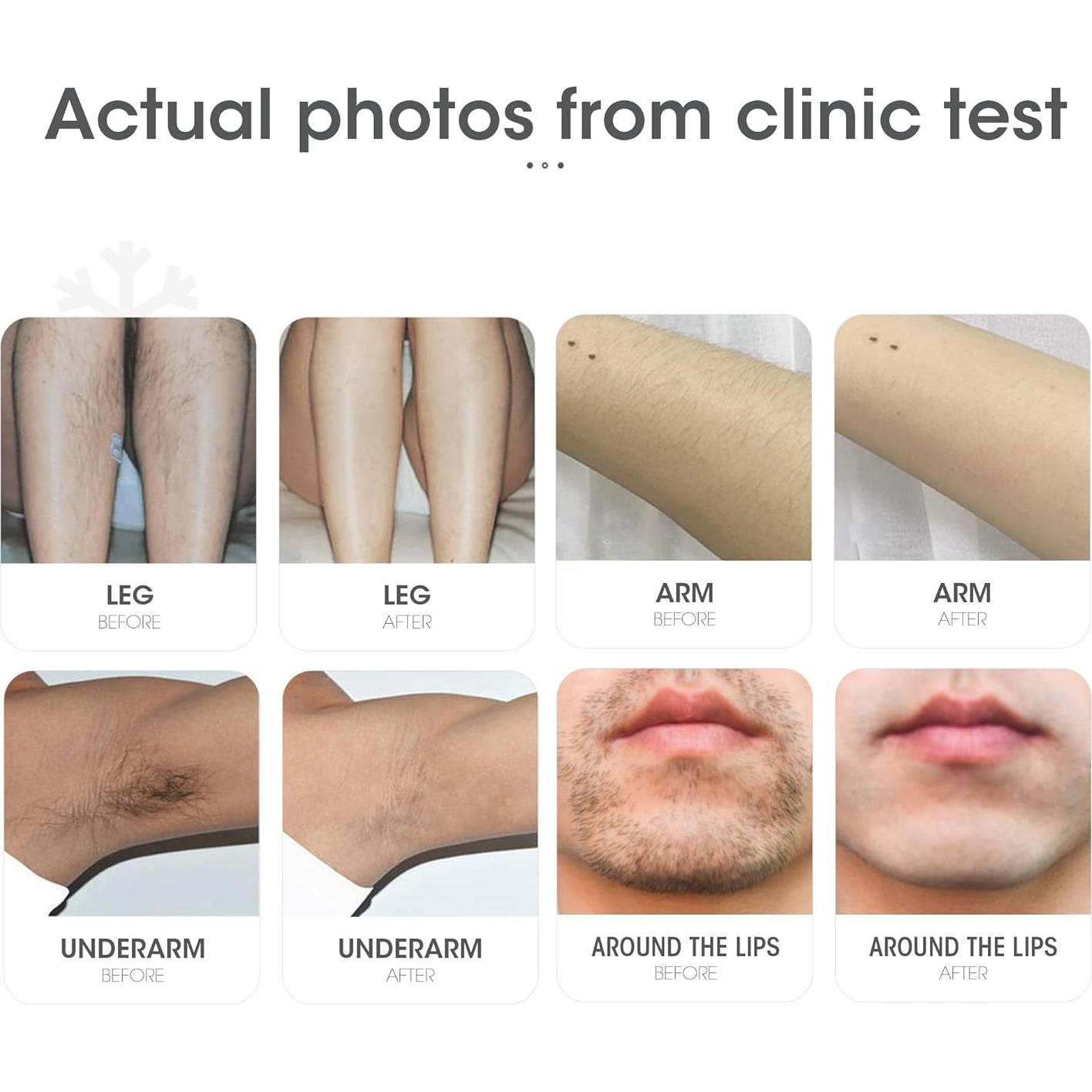 DEESS Removedor de Vello IPL GP591 con Compresión Fría 3-en-1