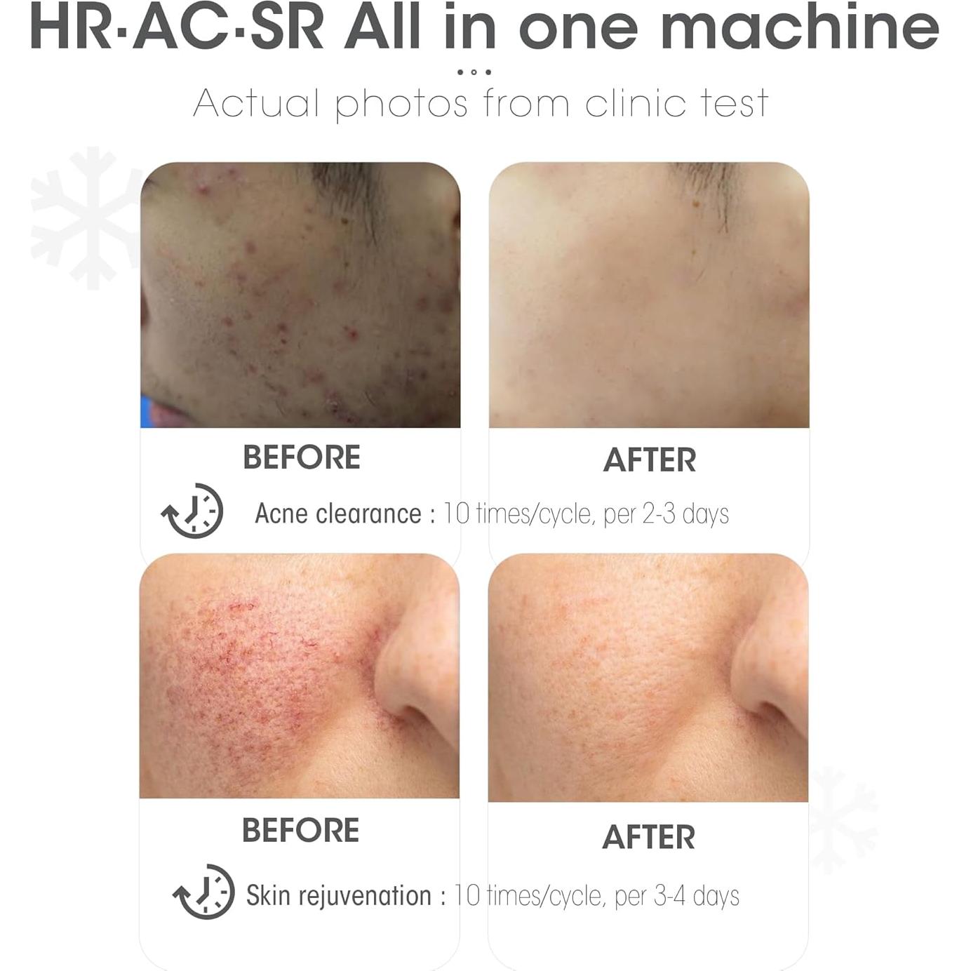 DEESS Removedor de Vello IPL GP591 con Compresión Fría 3-en-1