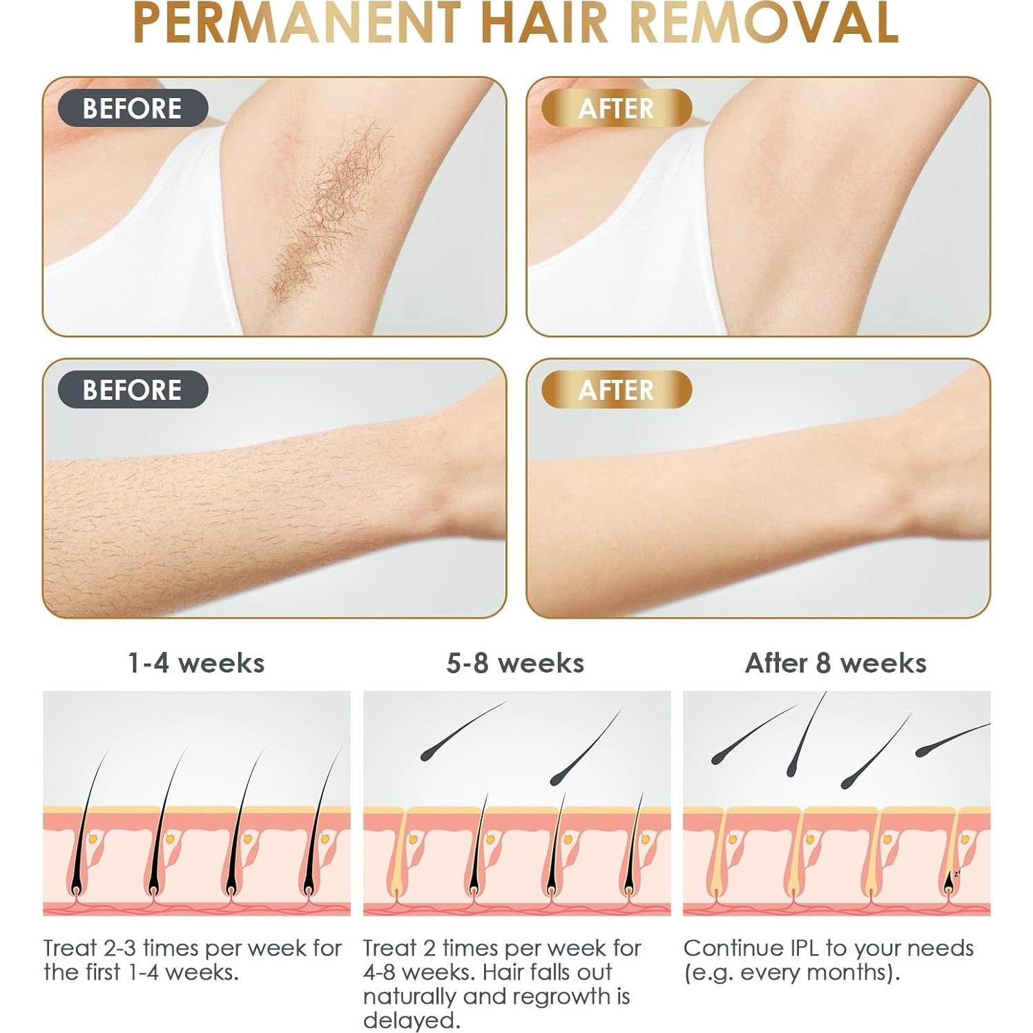 Depiladora Láser IPL NATRSYM para Uso en Casa - Indolora y Efectiva