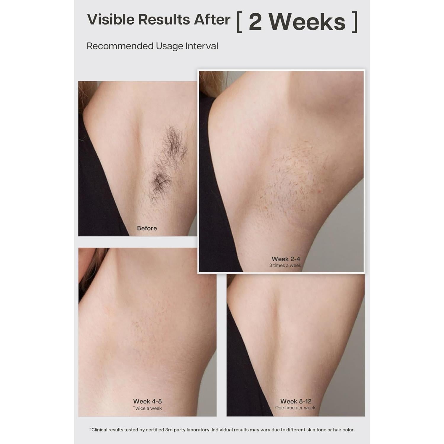 Dispositivo IPL LYRA para Eliminación de Vello - Enfriamiento Zafiro