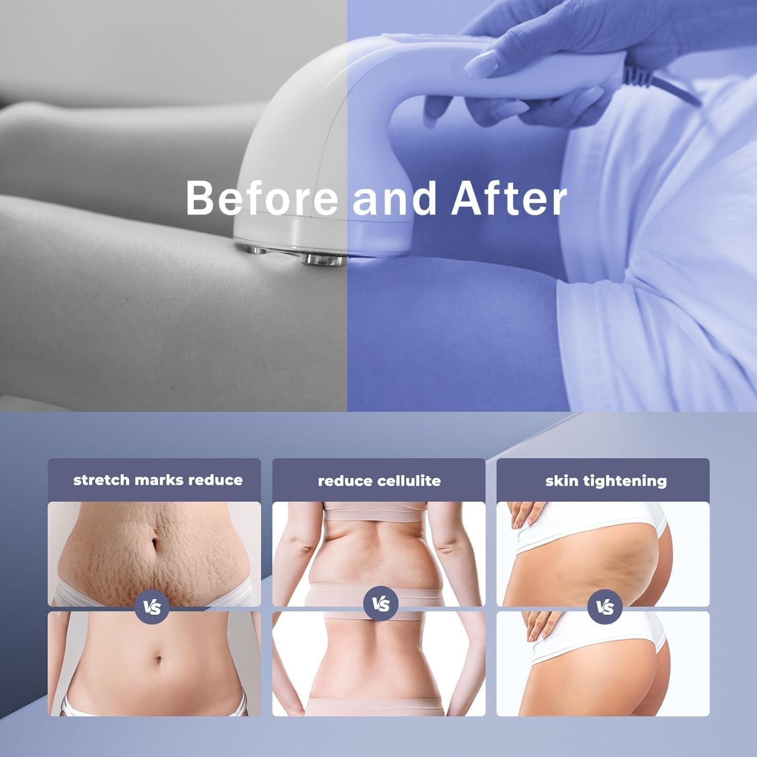 Dispositivo de Celulitis por Radiofrecuencia Pakerler 1.13kg