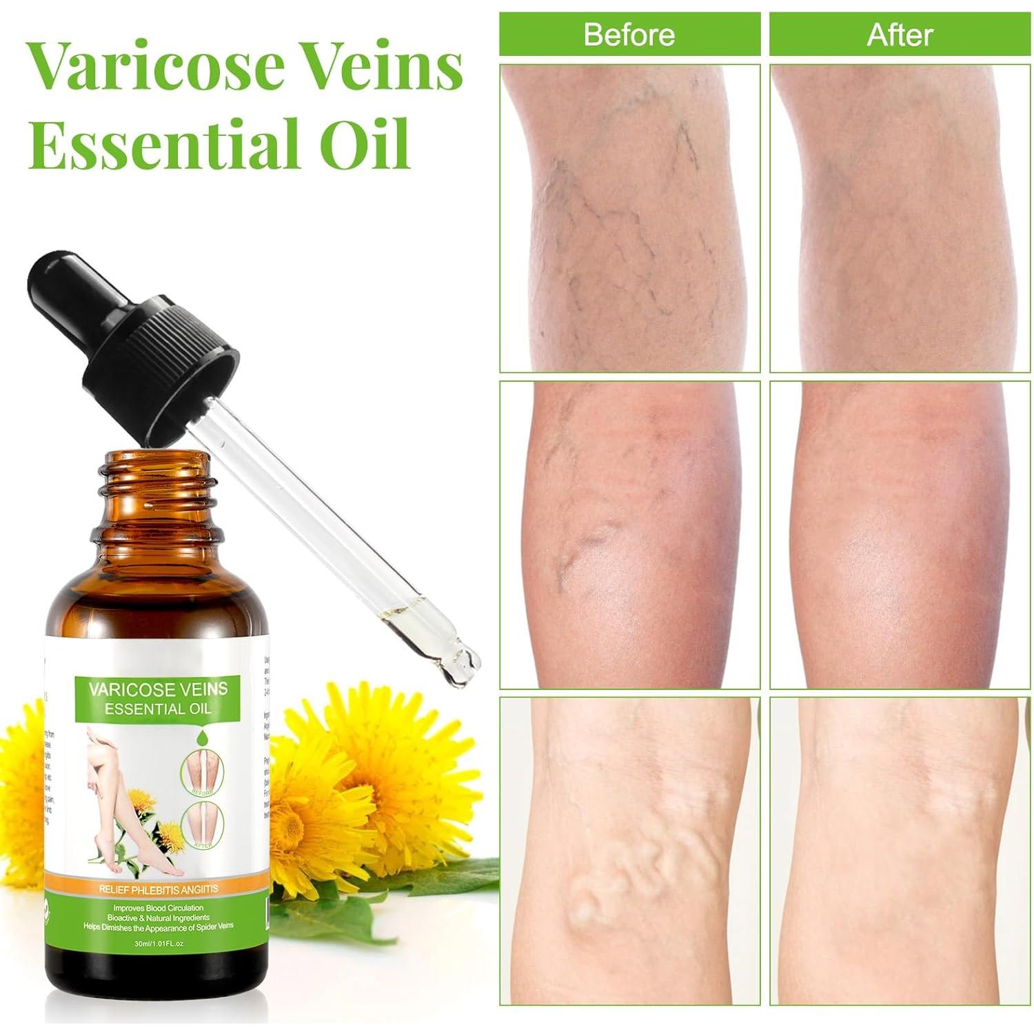 Aceite Esencial IKZEE para Venas Varicosas 30ML - Hidratante