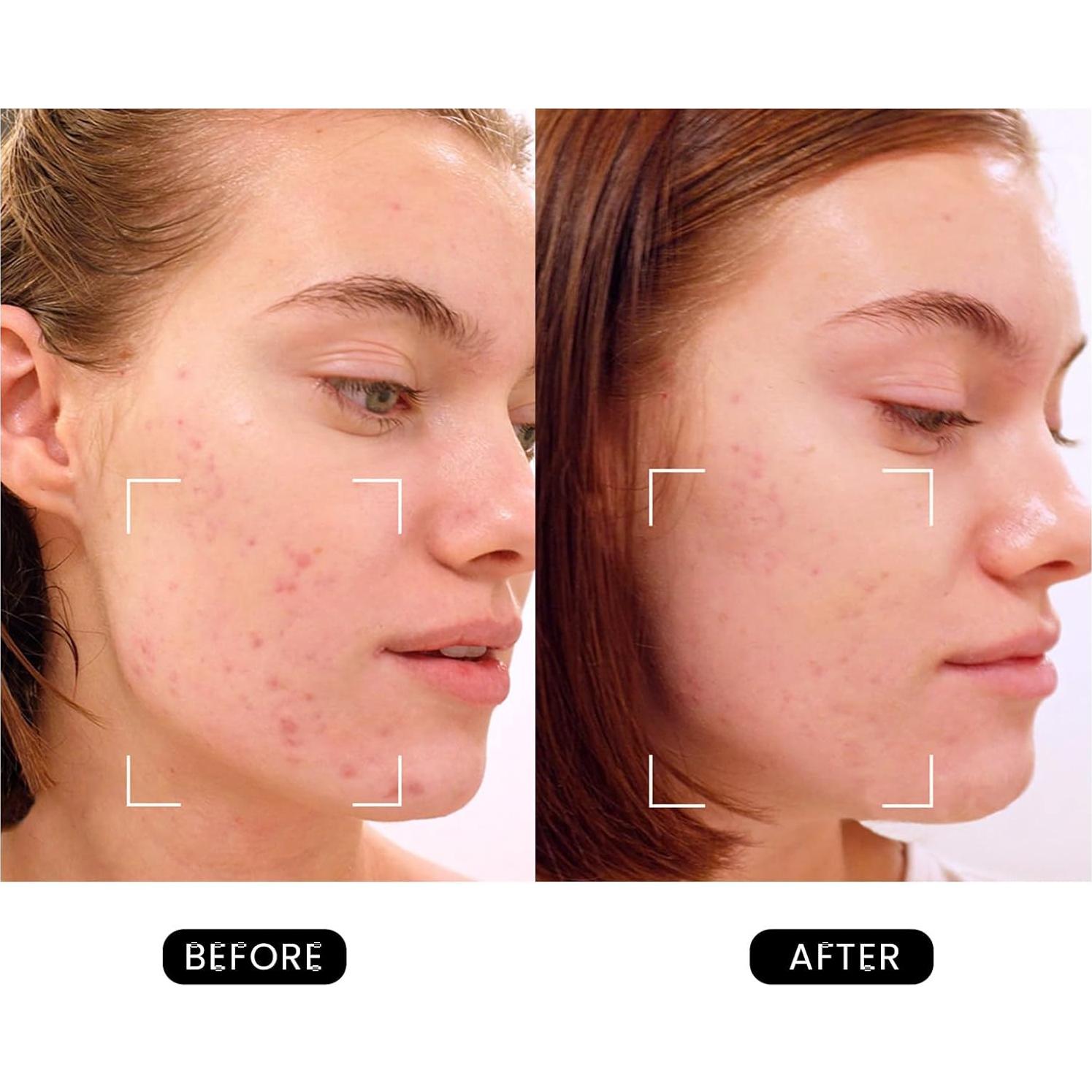 Dispositivo Facial Antienvejecimiento DermRays Revive 1064nm