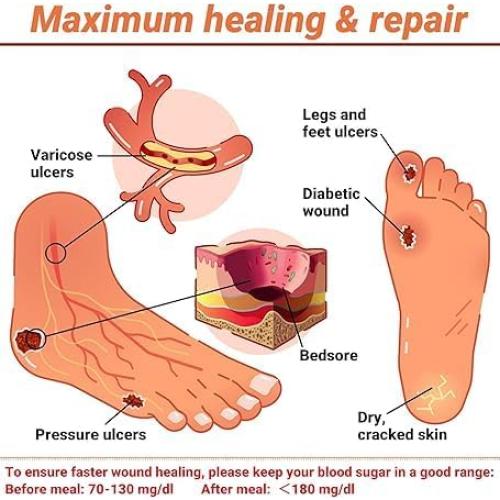 Crema para Úlceras Diabéticas iShanCare 50g - Alivio Rápido