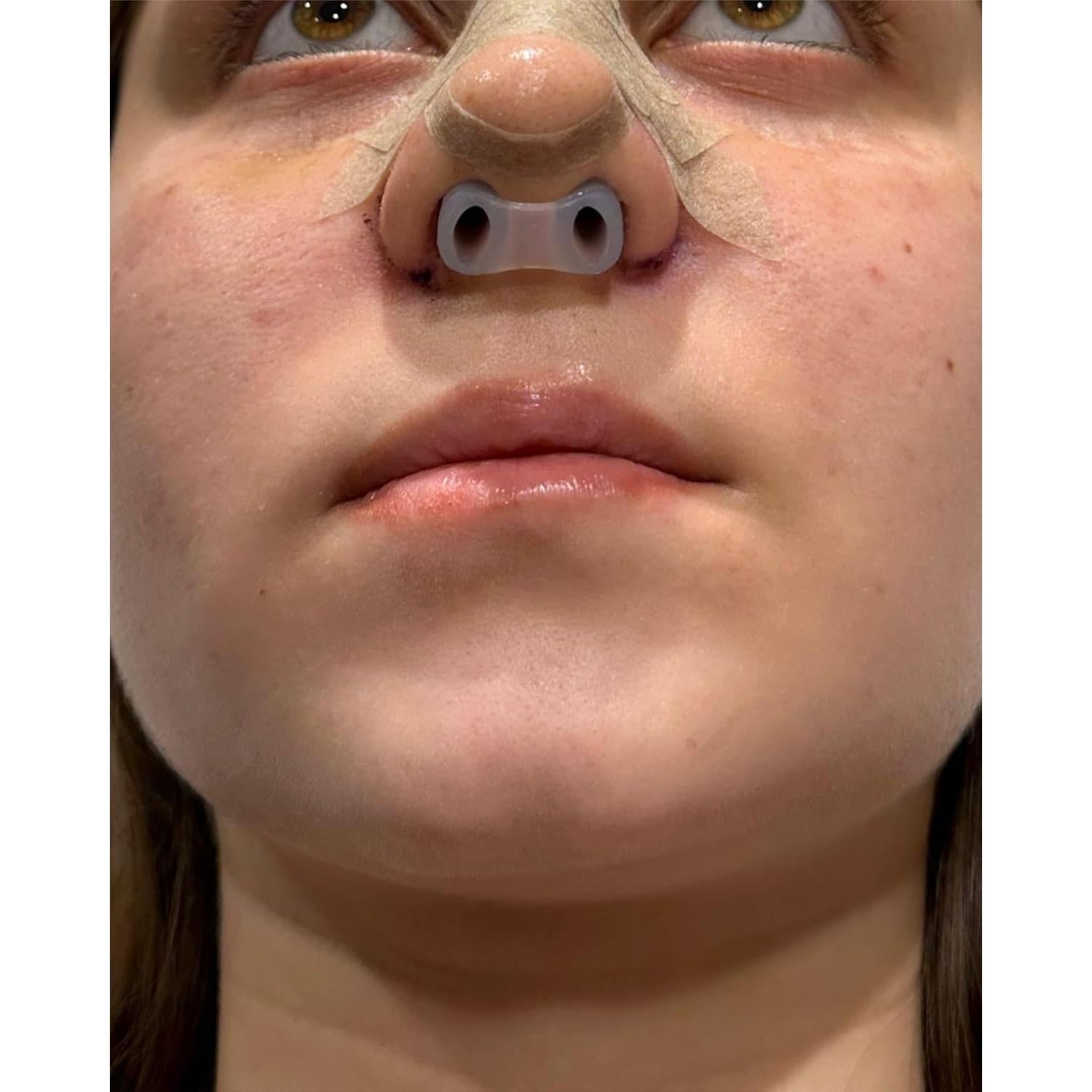 Retenedor de Nostril Footline para Recuperación de Rinoplastia 6