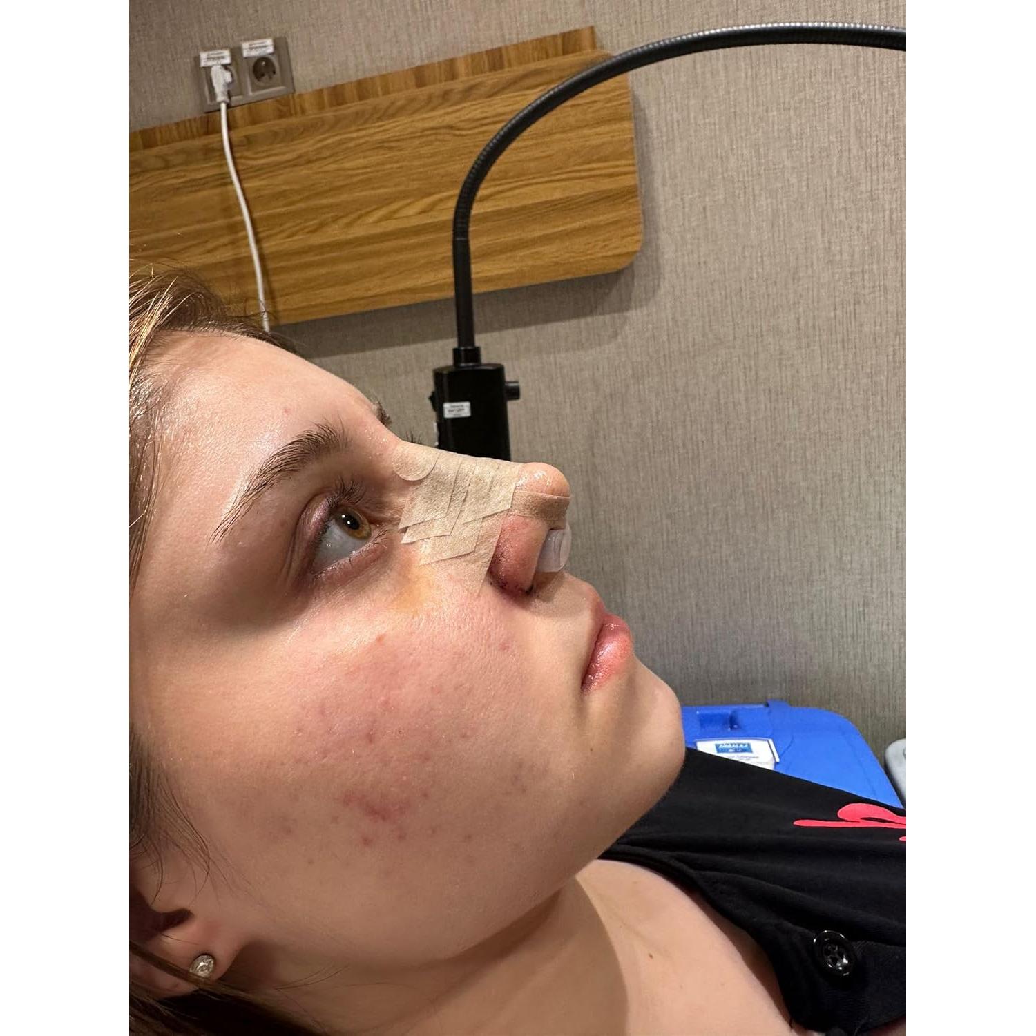 Retenedor de Nostril Footline para Recuperación de Rinoplastia 6