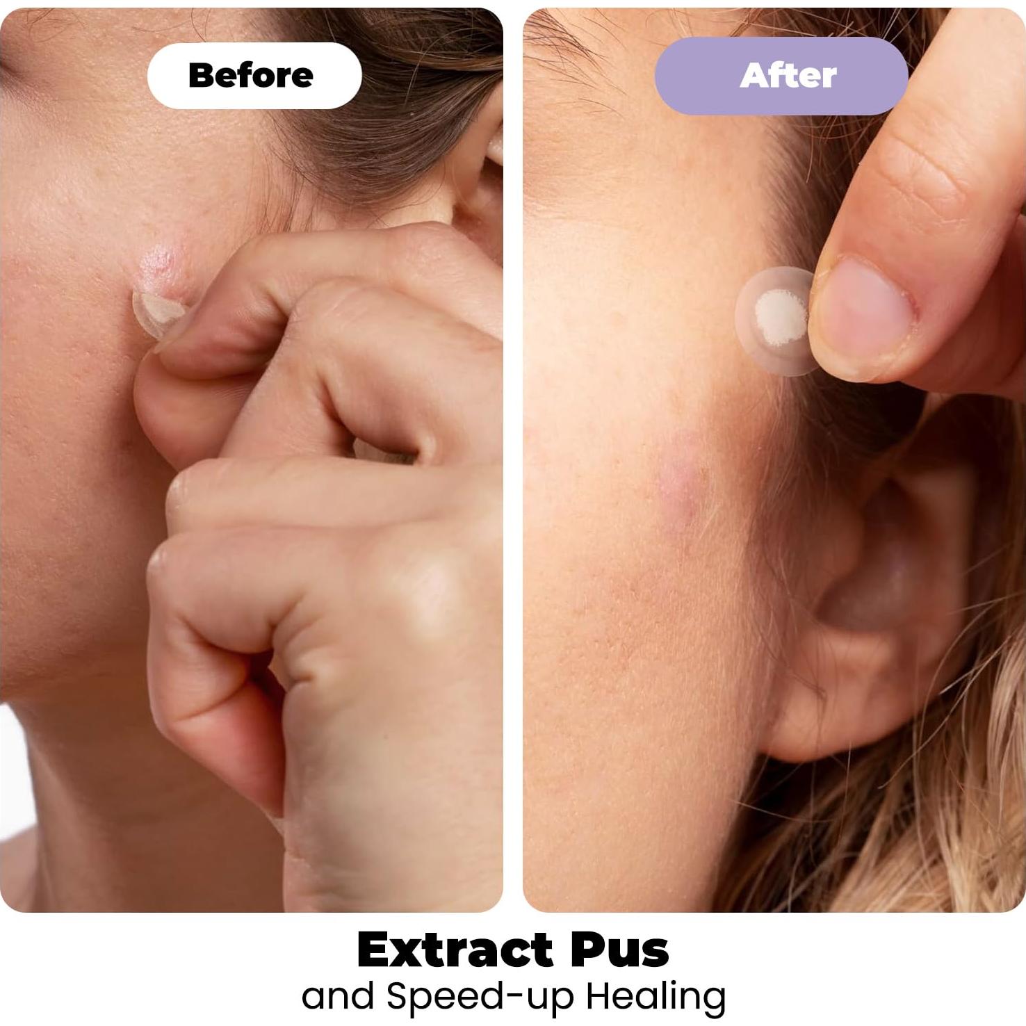 Parches Hidrocoloides RoselynBoutique para Granitos - 30 Unidades