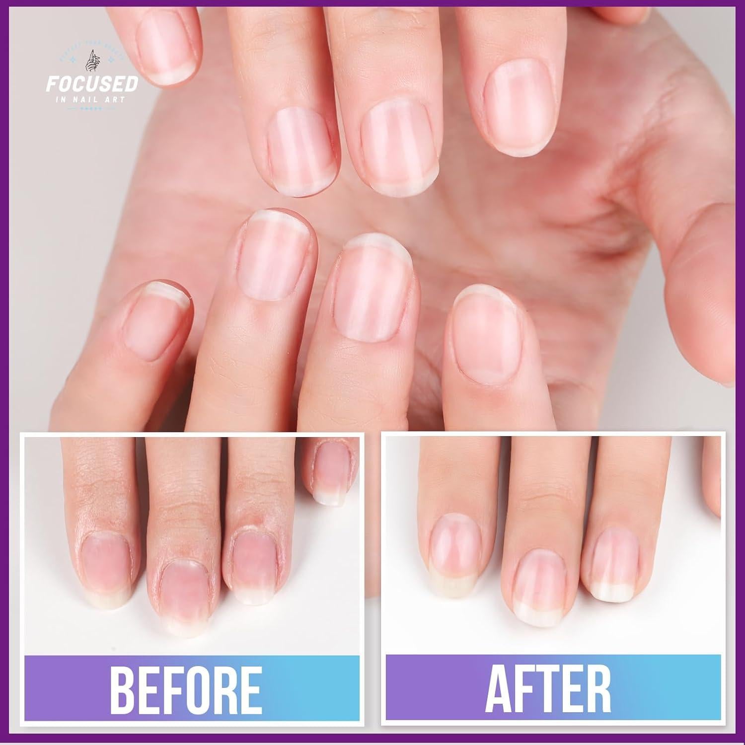 Kit de Cuidado de Uñas Teenitor - Removedor de Cutículas y Lima