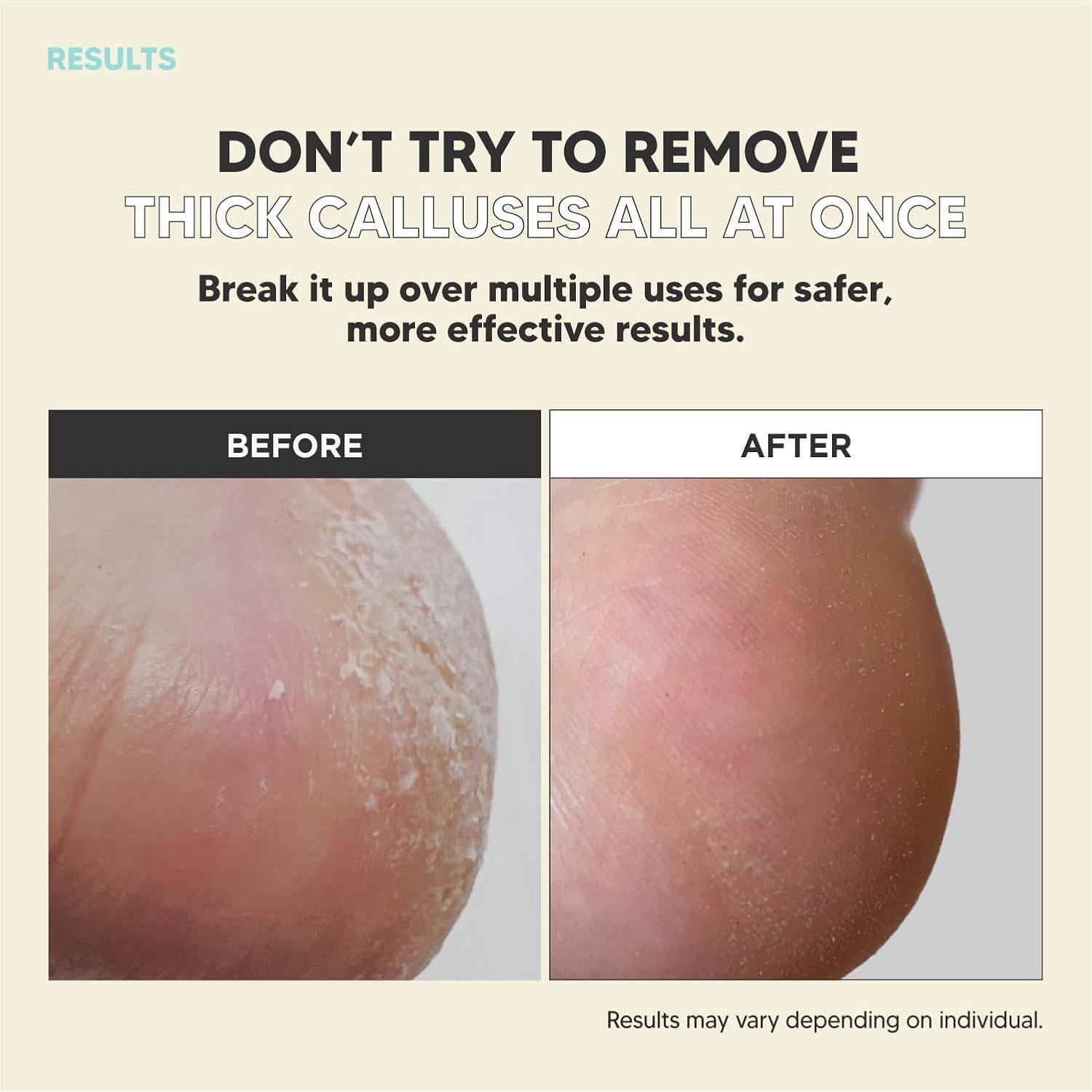 Rasuradora de Callos MAX-MATE de Acero Inoxidable Ergonómica