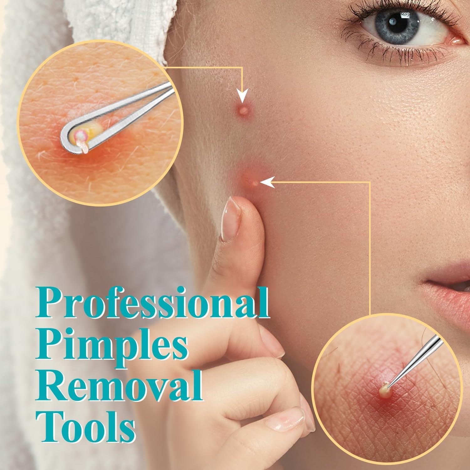 Kit de Herramientas MORGLES para Puntos Negros y Espinillas, 10 Piezas