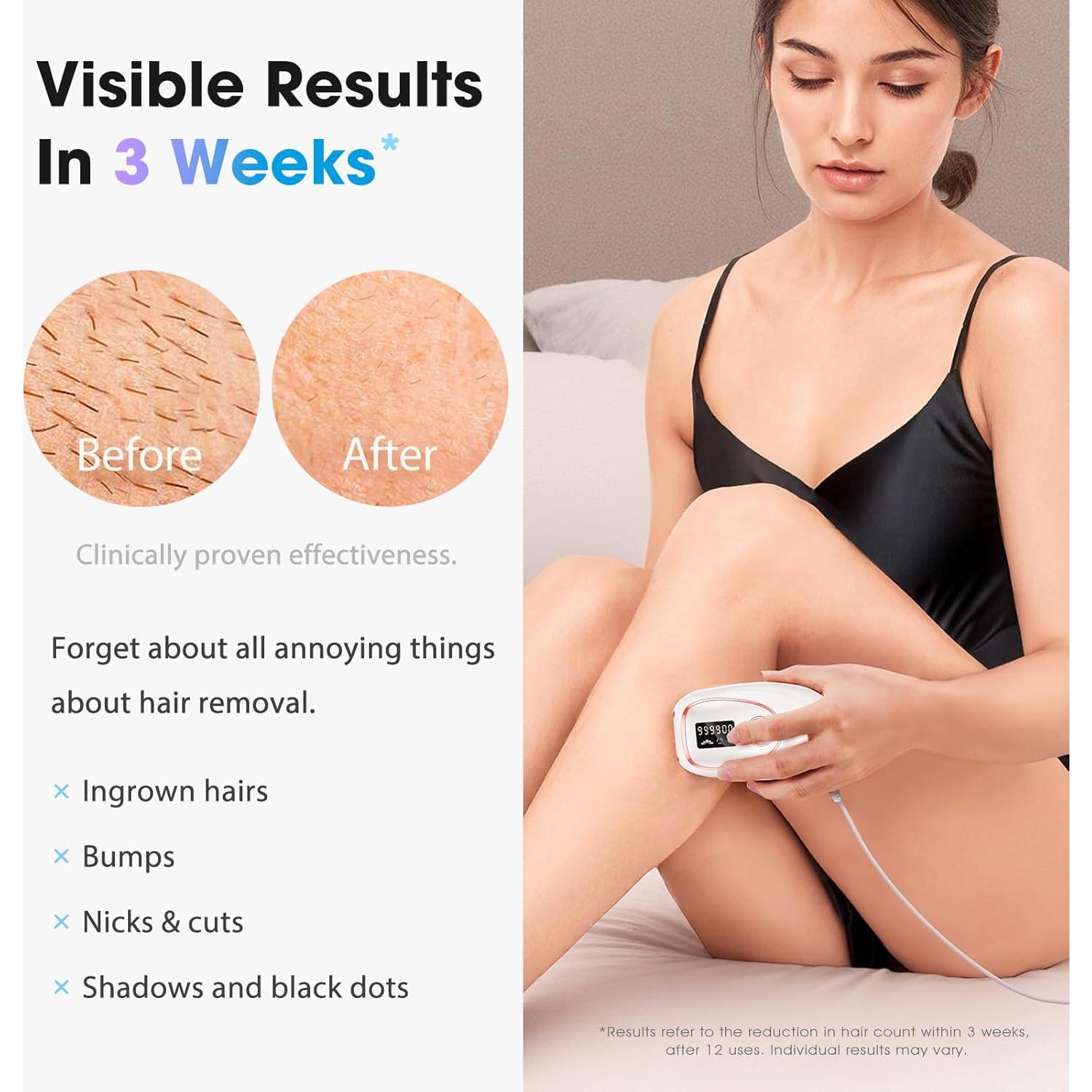 Depiladora Láser IPL Dongguan TM002 - Sin Dolor, 999K Destellos