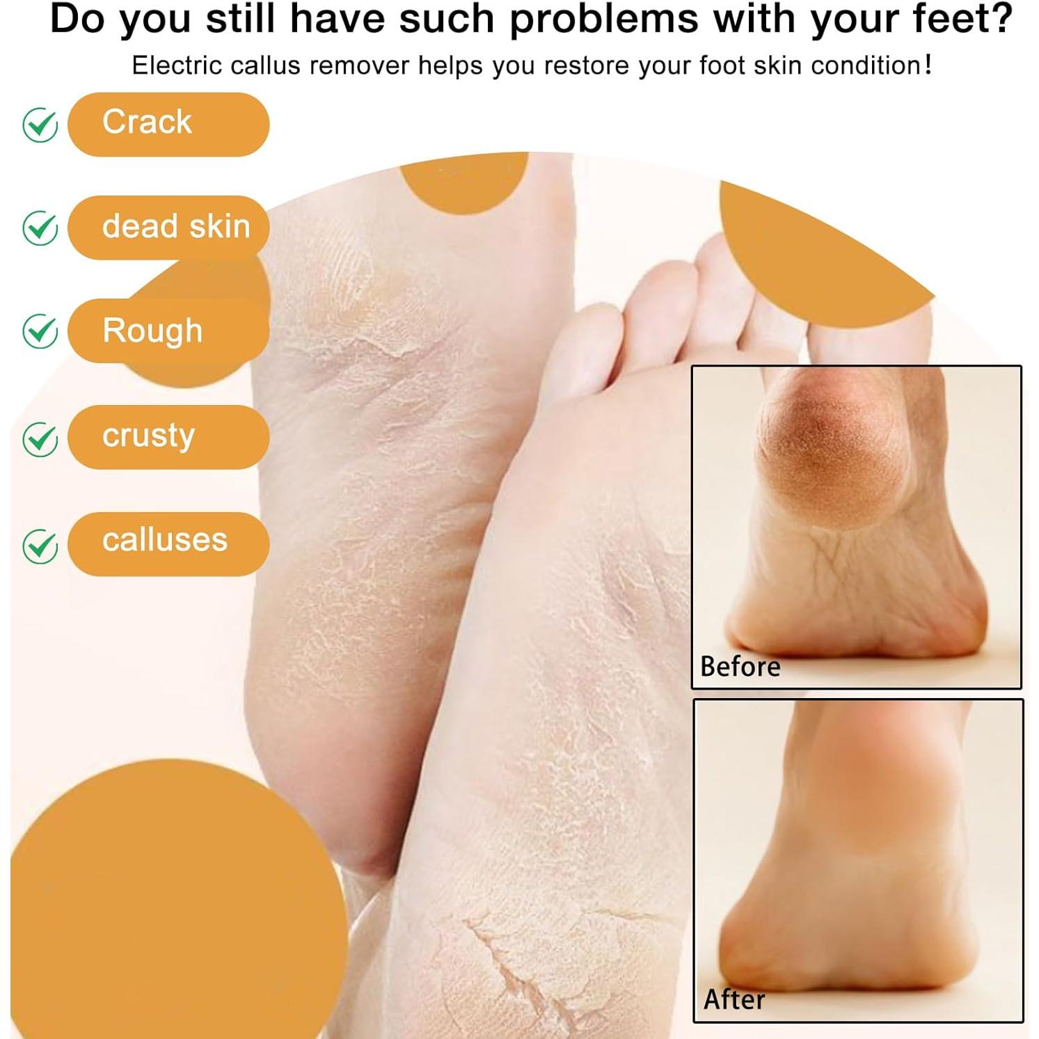 Removedor de Callos Eléctrico YOUSHEME DDMCS Azul con Pantalla LCD