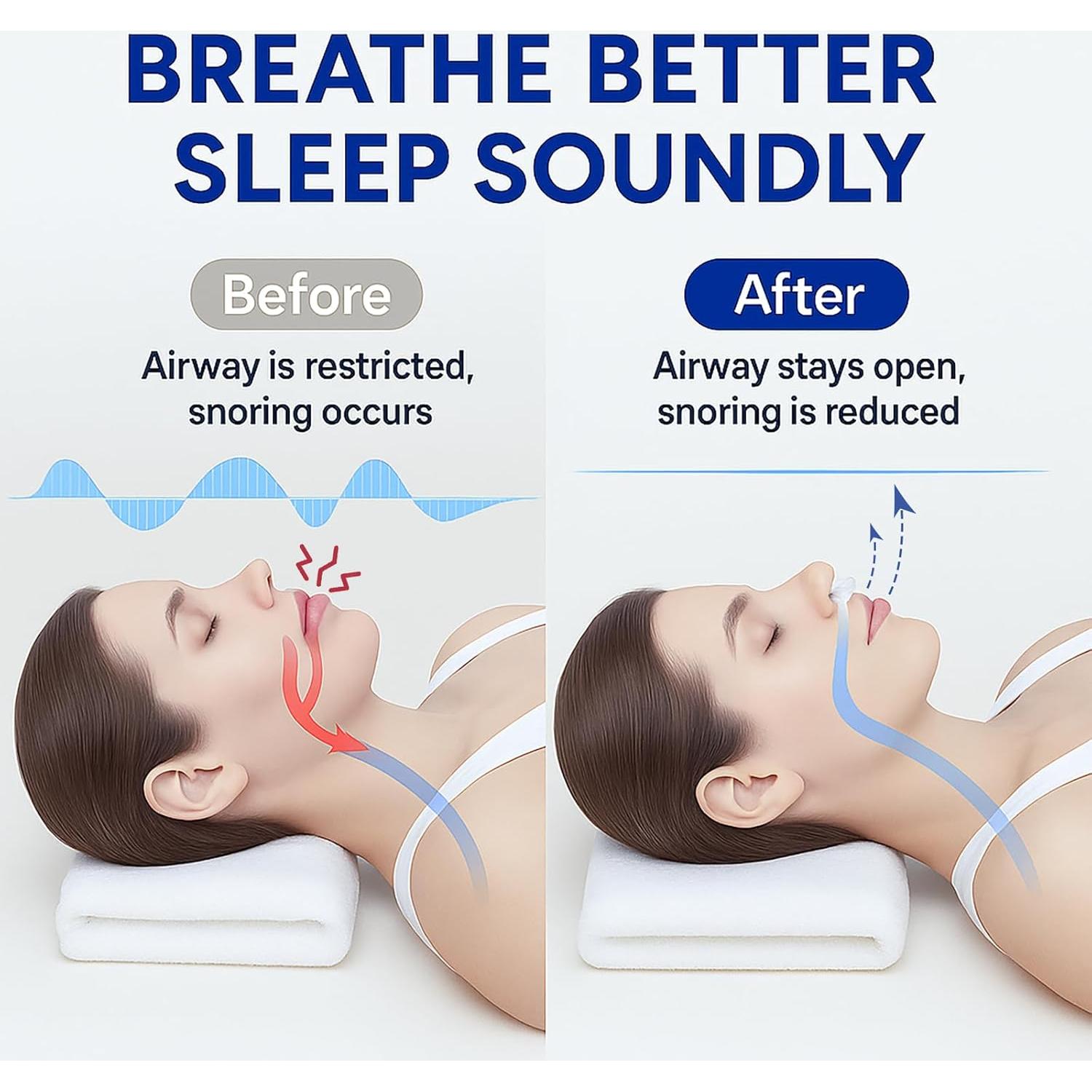 Dispositivos Anti Ronquidos Eovvoe - Paquete de 4, Ajuste Personalizado