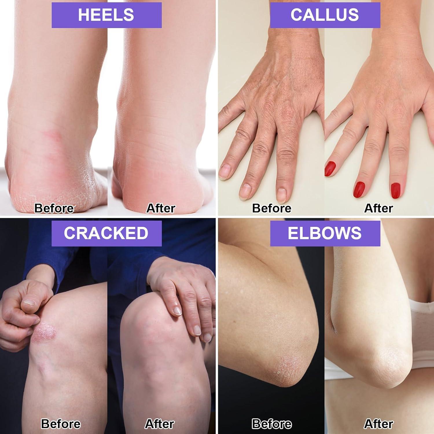 2 Paquetes Crema de Urea 42% y Ácido Salicílico 2% para Pies