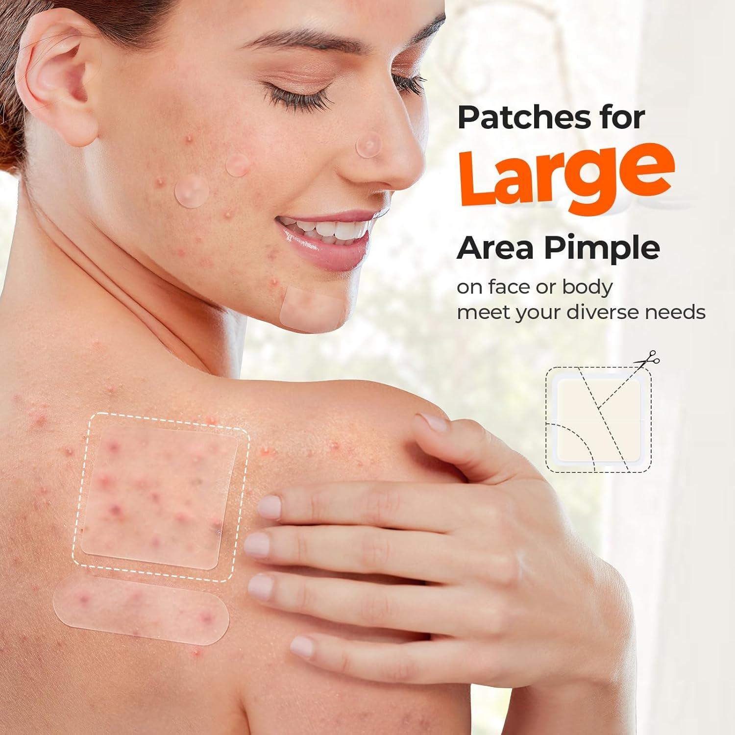 Parches Hidrocoloides TKTK 45x45 mm para Granitos - 120 Piezas