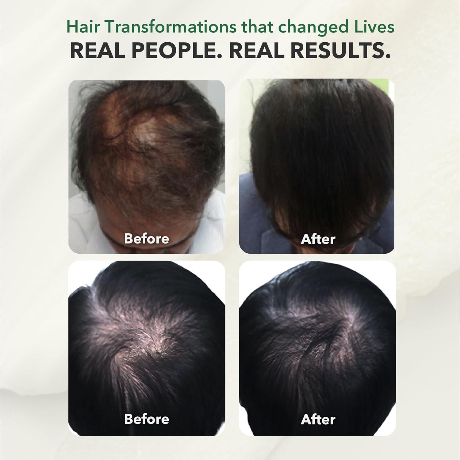 Bloqueador DHT HairSmart para Crecimiento del Cabello - 3 Paquetes