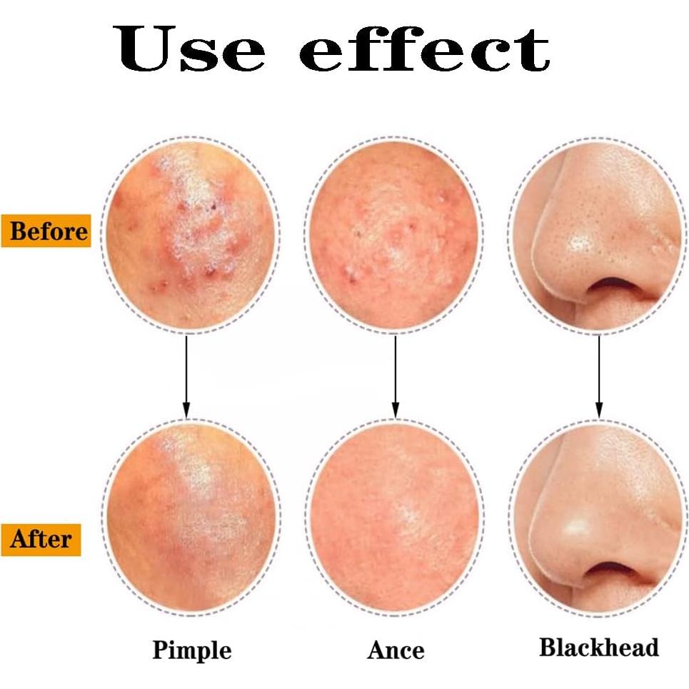 Kit Removedor de Puntos Negros BLAAROOM 3 Piezas Acero Inoxidable