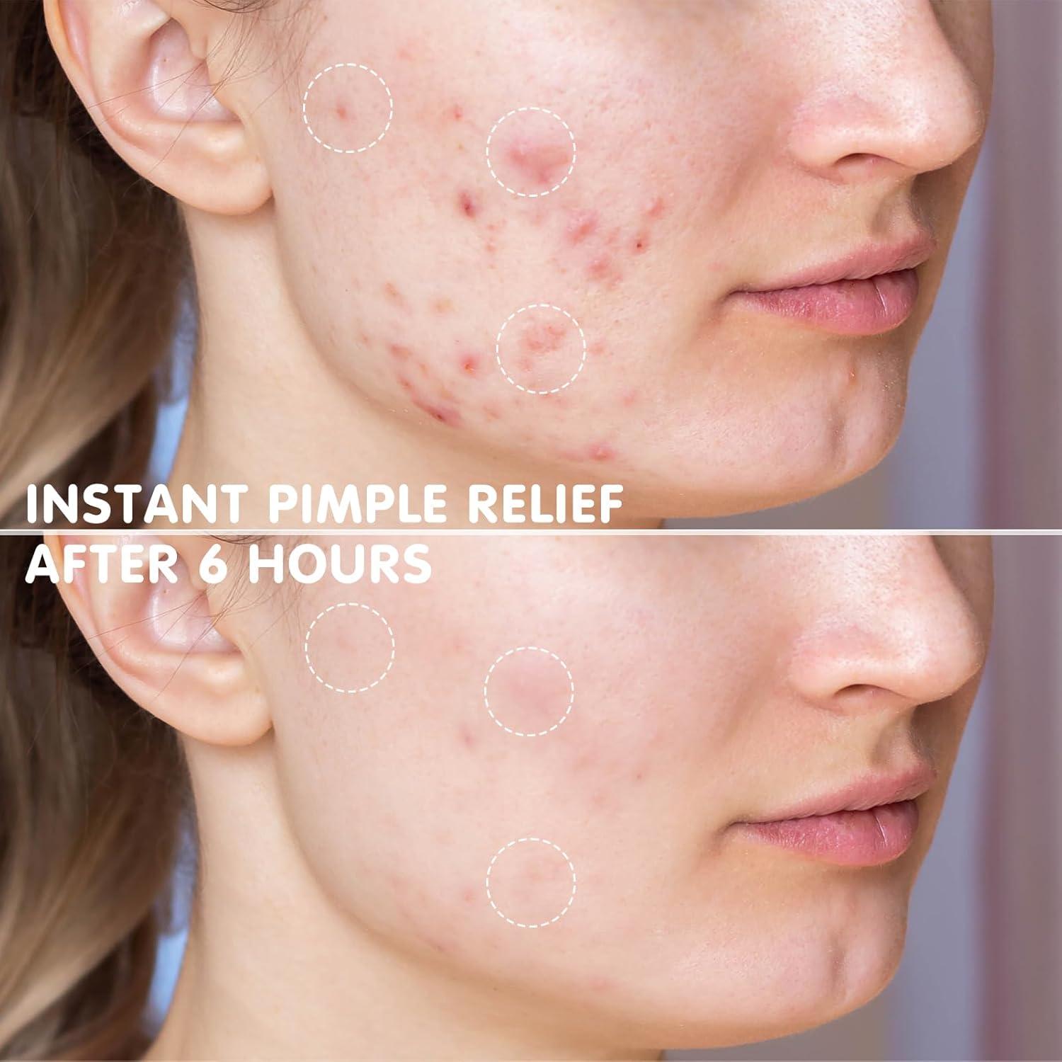 Parche Hidrocoloide para Granos AUSLKA - 150 Unidades Azul