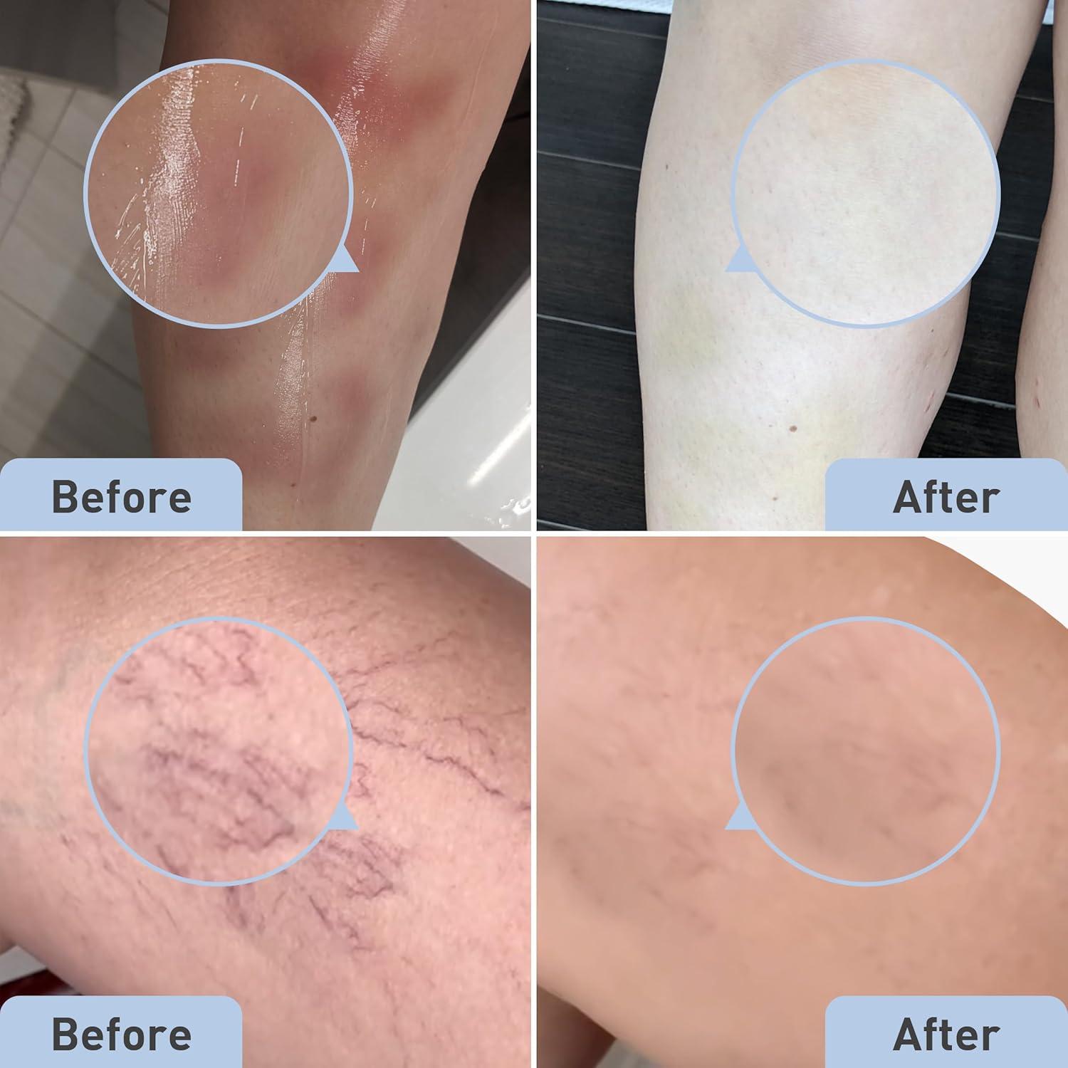 Gel PROcure Remedy con Arnica 59 ml - Alivio para Moretones