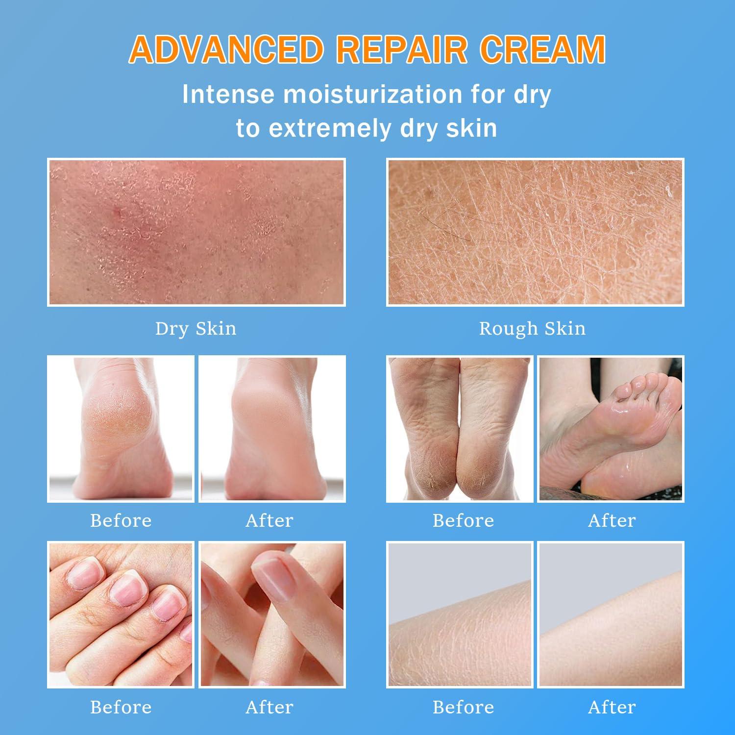 Crema de Urea 60% YOUNGYOUNGLOVE 150ml Hidratante para Pies