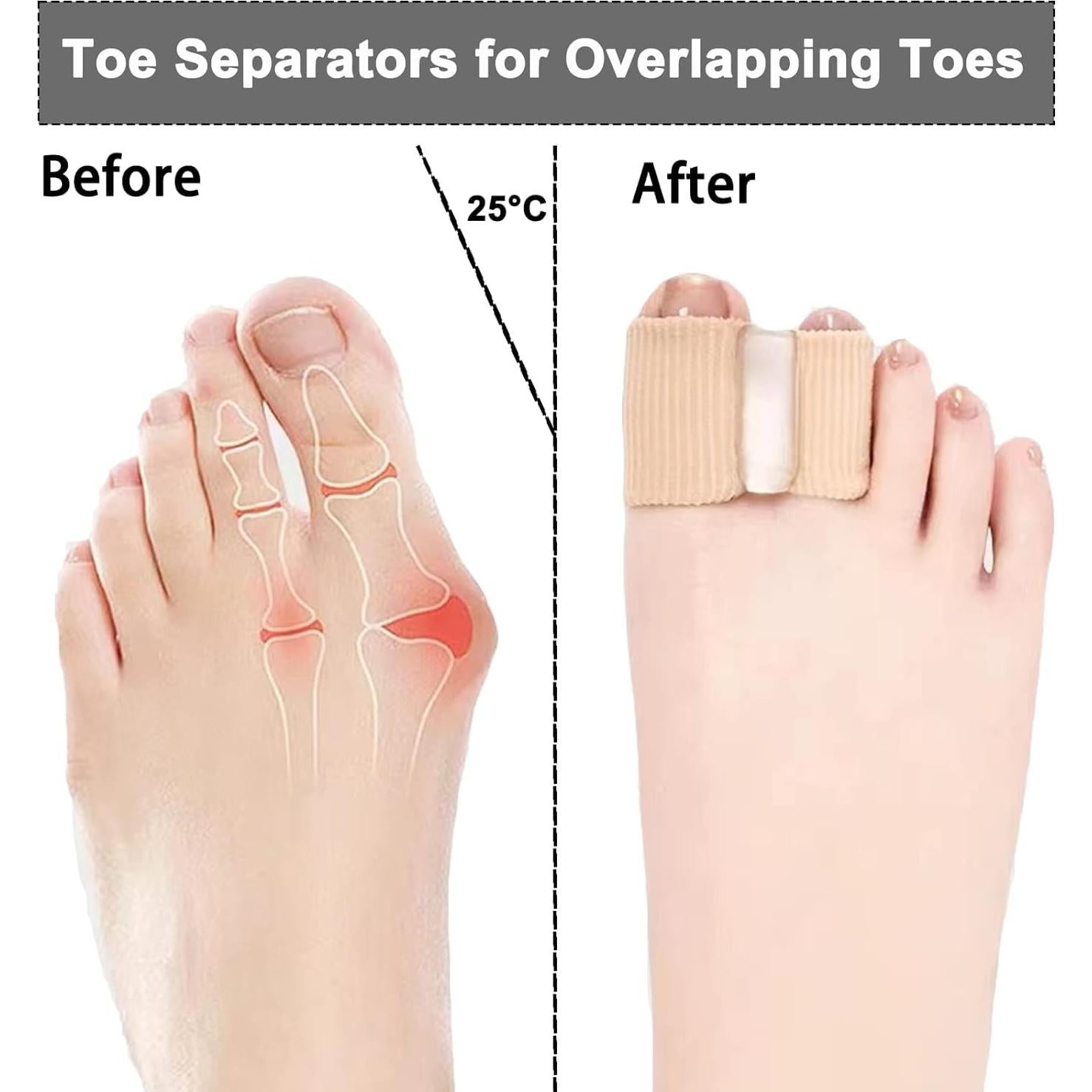 Separadores de Dedos de Gel Whycalon 2PCS para Juanetes