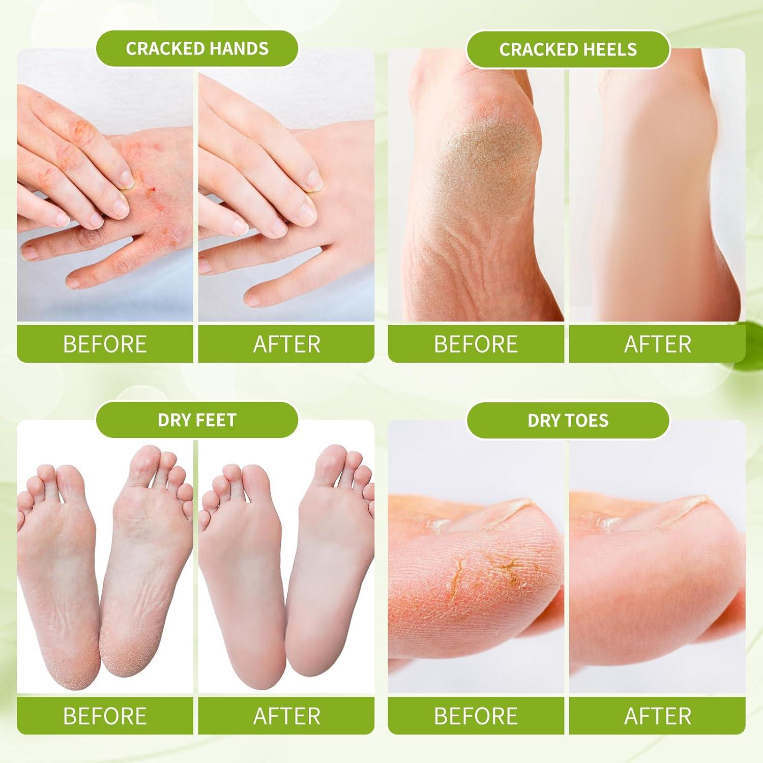 Removedor de Callos Loción Hidratante 250ml Limón